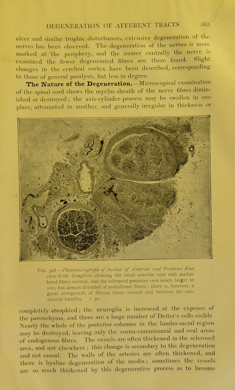 ulcer and similar trophic disturbances, extensive degeneration of tlie nerves has been observed. The degeneration of the nerves is more marked at the periphery, and the nearer centrally the nerve is examined the fewer degenerated fibres are there found. Slight chanoes in the cerebral cortex have been described, corresponding to those of general paralysis, but less in degree. The Nature of the Degeneration.—Microscopical examination of the spinal cord shows the myelin-sheath of the nerve fibres dimin- ished or destroyed; the axis-cylinder-process may be swollen in one place, attenuated in another, and generally irregular in thickness or : — — ■ ■ ■ ■ - ■ ry- --/r^r-^'tt^ Fig. —Photomicrograph of Section of Anterior and Posterior Root close to the Ganglion, showing the small anterior root with mediil- lated fibres normal, and the sclerosed posterior root much larger in size, but almost denuded of medullated fibres ; there ii, however, a great overgrowth of fibrous tissue around and between the con- stituent bundles. x 30. completely atrophied; the neuroglia is increased at the expense of the parenchyma, and there are a large number of Deiter's cells visible Nearly the whole of the posterior columns in the lumbo-sacral region may be destroyed, leaving only the cornu-commissural and oval areas of endogenous fibres. The vessels are often thickened in the sclerosed area, and not elsewhere ; this change is secondary to the degeneration and not cau.sa]. The walls of the arteries are often thickened, and there is hyaline degeneration of the media; sometimes the vessels are so much thickened by this degenerative process as to become