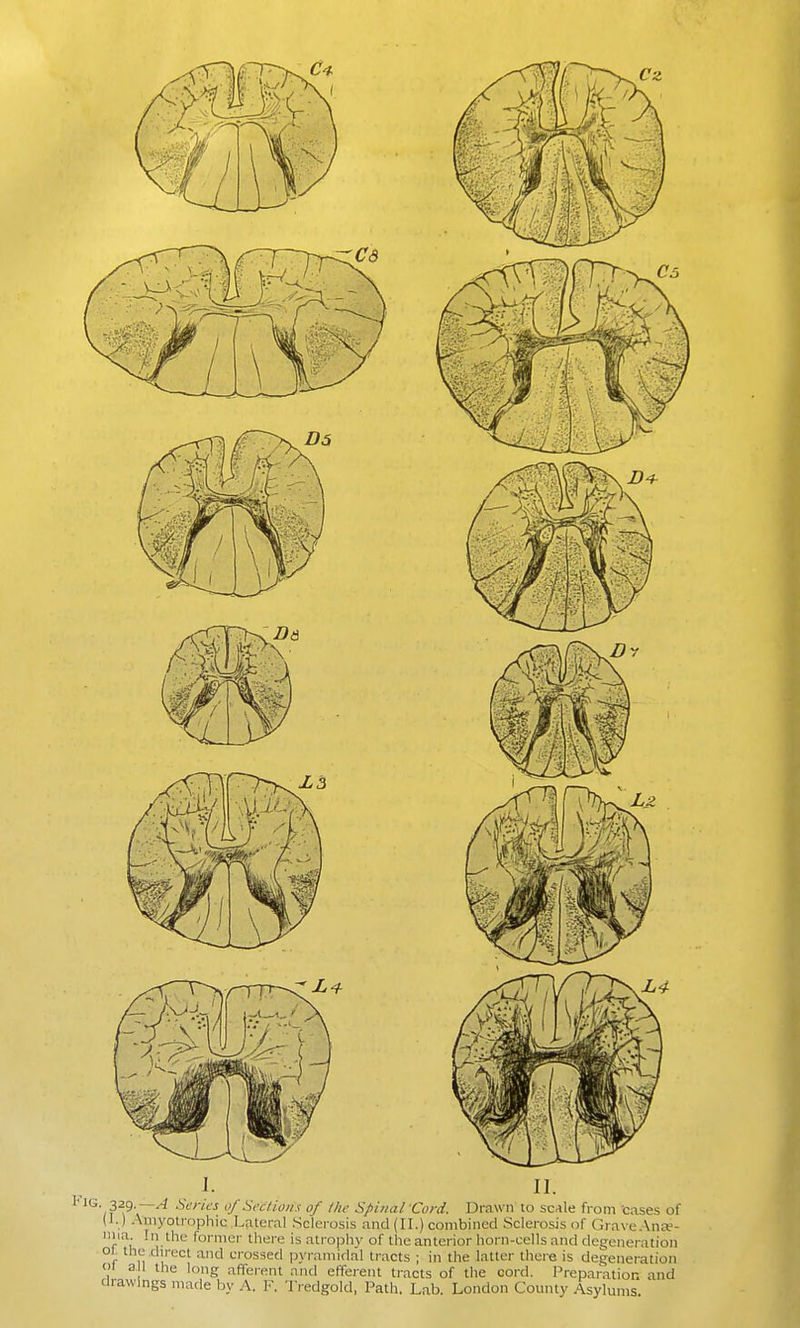i'lG 329 6V/7t'j of Sections of the Spinal Cord. Drawn to scAle from cases of (1.) Amyotrophic Lateral Sclerosis and (II.) combined Sclerosis of Grave.Xnce- niia In the former there is atrojjhy of the anterior horn-cells and degeneration °f i''^'^' '^^^^ crossed pyramidal tracts ; in the latter there is degeneration 1 a 1 the long afferent and efterenl tracts of the cord. Preparation and drawings made by A. F. 'IVedgold, Path. Lab. London County Asylums.