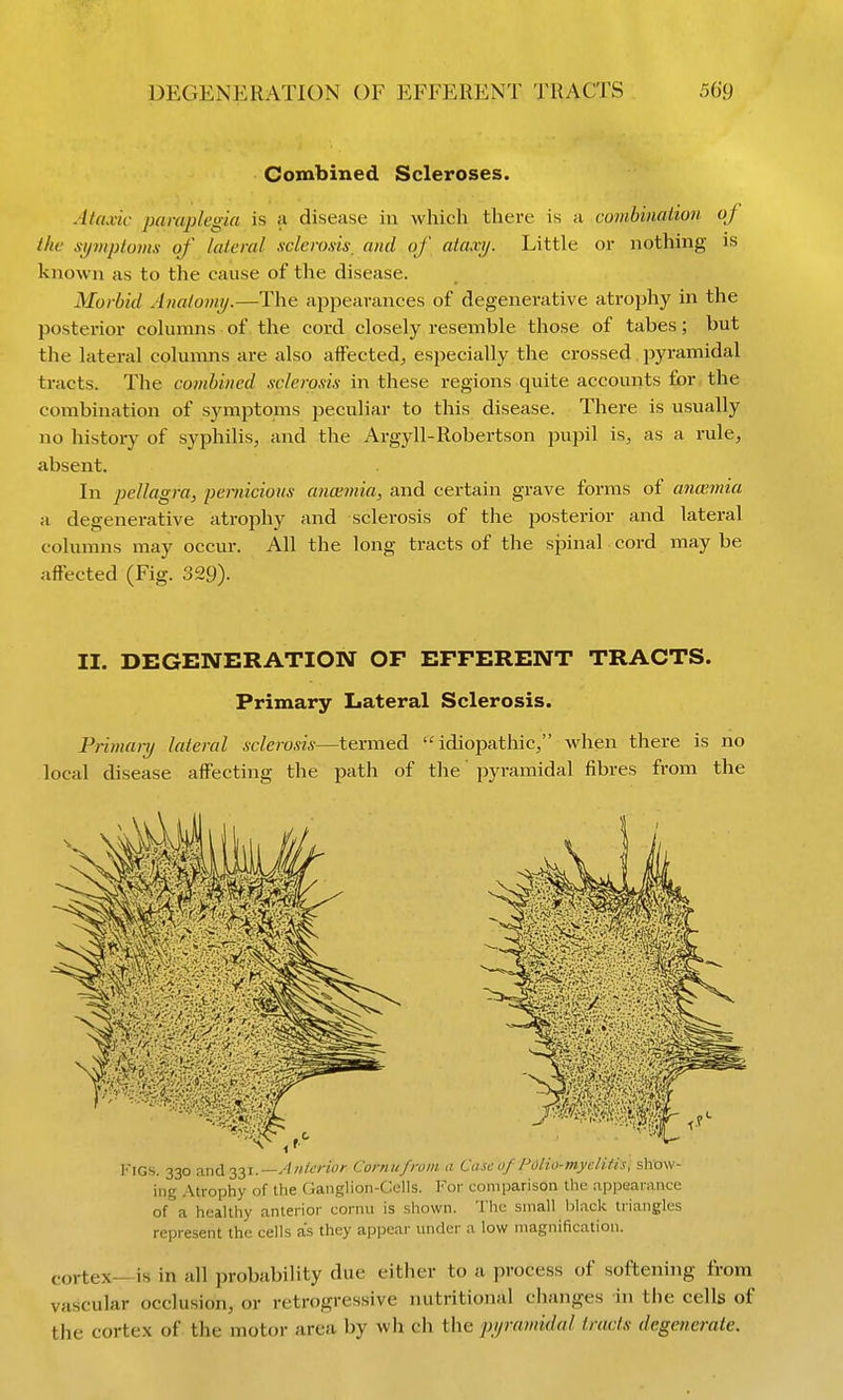 Combined Scleroses. Ataxic paraplegia is a disease in which there is a cumbinaiion of the sifinptoms of lateral sclero,sis_ and of ataxij. Little or nothing is known as to the cause of the disease. Morbid Anatomy.—The appearances of degenerative atrophy in the posterior columns of the cord closely resemble those of tabes; but the lateral columns are also afFected^ especially the crossed pyramidal tracts. The combined sclerosis in these regions quite accounts for the combination of symptoms peculiar to this disease. There is usually no history of syphilis, and the Argyll-Robertson pupil is, as a rule, absent. In pellagra, pernicious ancemia, and certain grave forms of anosmia a degenerative atrophy and sclerosis of the posterior and lateral columns may occur. All the long tracts of the spinal cord may be affected (Fig. 329)- II. DEGENERATION OF EFFERENT TRACTS. Primary Lateral Sclerosis. Primaiy lateral sclerosis—termed idiopathic, when there is no local disease affecting the path of the pyramidal fibres from the Figs. 330 an(!i2,o,x.—A)iierior Cornufrum a Case of Polio-myelitts; show- ing Atrophy of the Ganglion-Cells. For comparison the appearance of a healthy anterior cornu is shown. The small black triangles represent the cells as they appear under a low magnification. cortex—is in all probability due either to a process of softening from vascular occlusion, or retrogressive nutritional changes in the cells of the cortex of the motor area by wh ch the pyramidal tracts degenerate.