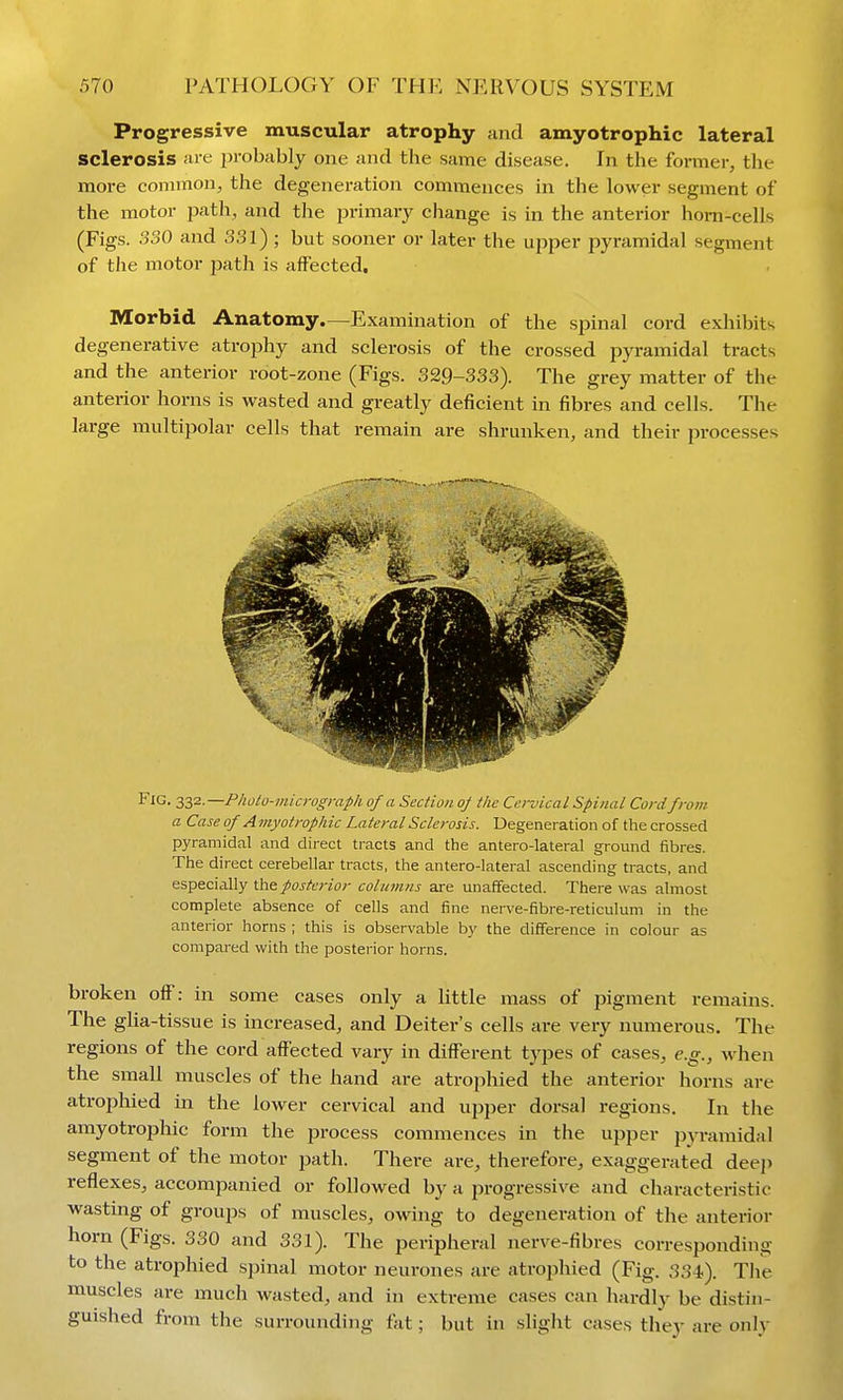 Progressive muscular atrophy and amyotrophic lateral sclerosis ;u-e in-obably one and the same disease. In the fomier, the more connnon, the degeneration commences in the lower segment of the motor path, and the primar}^ change is in the anterior horn-cells (Figs. 330 and 331) ; but sooner or later the upper pyramidal segment of the motor path is affected. Morbid Anatomy.—Examination of the sjjinal cord exhibits degenerative atrophy and sclerosis of the crossed j)yramidal tracts and the anterior root-zone (Figs. 329-333). The grey matter of the anterior horns is wasted and greatly deficient in fibres and cells. The large multipolar cells that remain are shrunken, and their processes Fig. 2,Z'^.—Photo-micrographof a Section o/ the Cervical Spinal Cordfrom a Case of A myotrophic Lateral Sclerosis. Degeneration of the crossed pyramidal and direct tracts and the antero-lateral ground fibres. The direct cerebellar tracts, the antero-lateral ascending tracts, and especially the posterior columns are unaffected. There was almost complete absence of cells and fine nerve-fibre-reticulum in the anterior horns ; this is observable by the difference in colour as compared with the posterior horns. broken olF: in some cases only a little mass of pigment remains. The glia-tissue is increased, and Deiter's cells are very numerous. The regions of the cord affected vary in different types of cases, e.g., when the small muscles of the hand are atrophied the anterior horns are atrophied in the lower cervical and upper dorsal regions. In the amyotrophic form the process commences in the upper pyi-amidal segment of the motor path. There are, therefore, exaggerated deep reflexes, accompanied or followed by a progressive and characteristic wasting of groups of muscles, owing to degeneration of the anterior horn (Figs. 330 and 331). The peripheral nerve-fibres corresponding to the atrophied spinal motor neurones are atrophied (Fig. 334.). Tlie muscles are much wasted, and in extreme cases can hardly be distin- guished from the surrounding fat; but in slight cases they are only