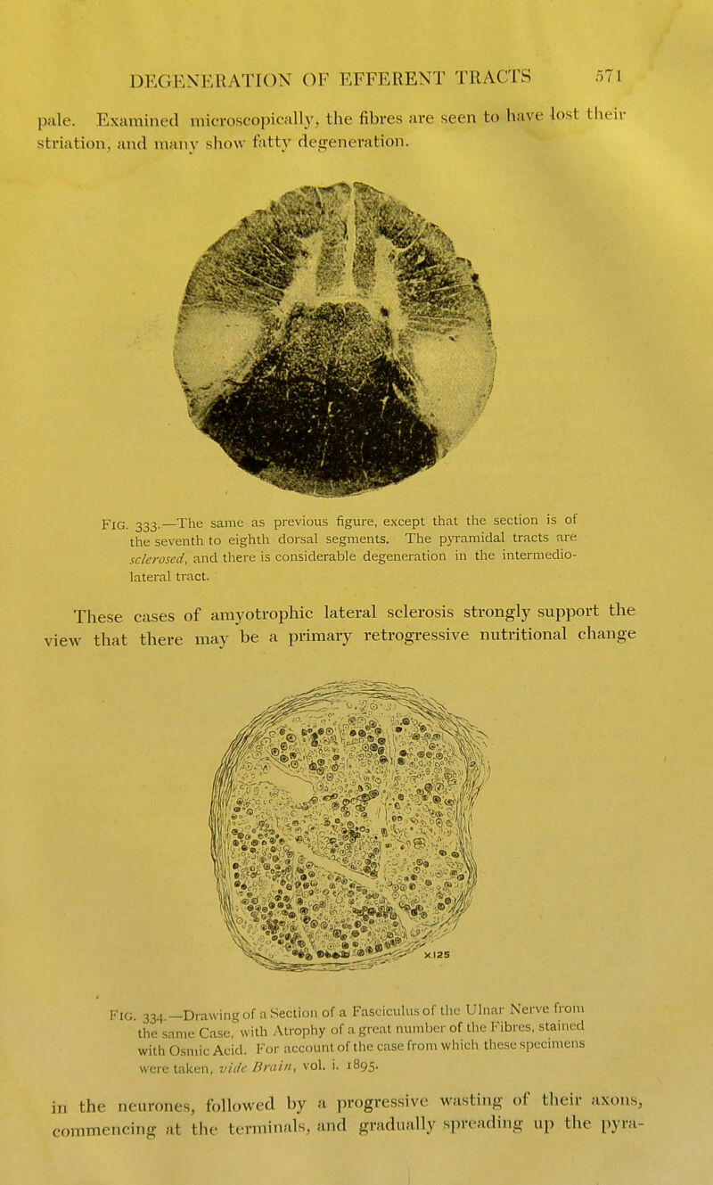 pale. Examined microscopically, the fibres are seen to have lost their striation, and many show fatty degeneration. Fig. 333.—The same as previous figure, except that the section is of the seventh to eighth dorsal segments. The pyramidal tracts are sclerosed, and there is considerable degeneration in the intermedio- lateral tract. These cases of amyotrophic lateral sclerosis strongly support the that there may be a primary retrogressive nutritional change Fig. 334.—Drawing of a Section of a Fasciculus of llie Ulnar Nerve from the same Case, with Atrophy of a great numljer of the Fibres, stained with Osmic Acid. For account of the case from whicli these spccnuens were taken, vide Brain, vol. i. 1895. in the neurones, followed by a progressive wasting of their axons, commencing at the terminals, and gradually .spreading up the pyra-