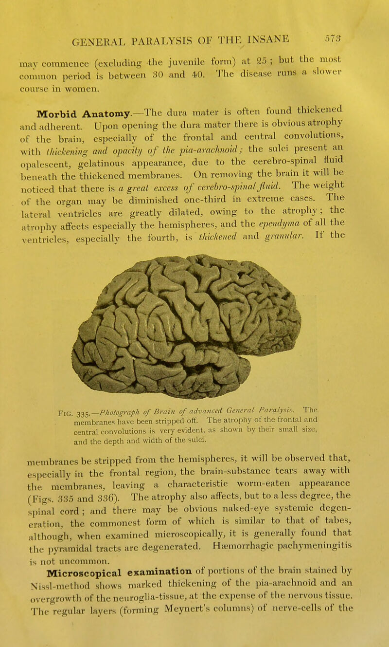 mav covnmence (excluding the juvenile form) at 25 ; but the most common period is between 30 and 40. ^Jhe disease runs a slower course in women. Morbid Anatomy.—The dura mater is often found thickened and adlierent. Upon opening the dura mater there is obvious atrophy of the brain, especially of the frontal and central convolutions, with thick-enhig and opacity of the pia-arachnoid; the sulci present an opalescent, g'elatinous appearance, due to the cerebro-siiinal fluid beneath the thickened membranes. On removing the brain it will be noticed that there is a great excess of cerehro-spinal fluid. Tlie weight of the organ may be diminished one-third in extreme cases. The lateral ventricles are greatly dilated, owing to the atrophy; the atrophy aflFects especially the hemispheres, and the ependyma of all the ventricles, especially the fourth, is thickened and granular. If the Pig. j^j^e,.—Photograph of Brain of advanced General Paralysis. The membranes have been stripped off. The atrophy of the frontal and central convolutions is very evident, as shown by their small size, and the depth and width of the sulci. membranes be stripped from the hemispheres, it will be observed that, especially in the frontal region, the brain-substance tears away with the membranes, leaving a characteristic worm-eaten appearance (Figs. 335 and 336). The atrophy also affects, but to a less degree, the spinal cord ; and there may be obvious naked-eye systemic degen- eration, the commonest form of which is similar to that of tabes, although, when examined microscopically, it is generally found that the pyramidal tracts are degenerated. Haemorrhagic pachymeningitis is not uncommon. Microscopical eKamination of portions of the brain stained by Nissl-method shows marked thickening of the pia-arachnoid and an overgrowth of the neuroglia-tissue, at the expense of the nervous tissue. The regular layers (forming Meynert's columns) of nerve-cells of the