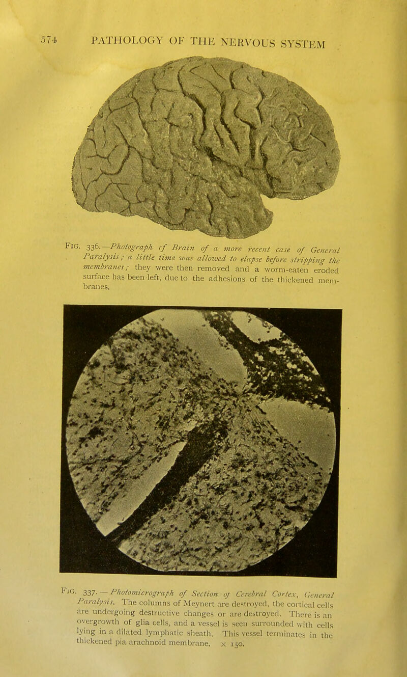!. 32,6.—Phoiograph rf Brain of a more recent case of General Paralysis; a little time was allowed to elapse before stripping the membranes; they were then removed and a worm-eaten eroded surface has been left, due to the adhesions of the thickened mem- branes. -'• 337- — Pliotoinicrograph of Section oj Cerebral Cortex, General Paralysis. The columns of Meynert arc destroyed, the cortical cells are undergoing destructive changes or are destroyed. There is an overgrowth of glia cells, and a vessel is seen surrounded with cells lying in a dilated lymphatic sheath. This vessel terminates in the thickened pia arachnoid membrane, x 150.