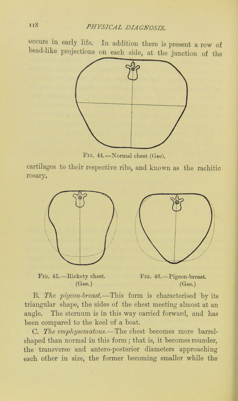 occurs in early life. In addition there is present a row of bead-like projections on each side, at the junction of the Fig. 44.—Normal chest (Gee). cartilages to their respective ribs, and knoAvn as the rachitic rosary. B. The pigeon-breast.—This form is characterised by its triangular shape, the sides of the chest meeting almost at an angle. The sternum is in this way carried forward, and has been compared to the keel of a boat. C. The emphysematous.—The chest becomes more barrel- shaped than normal in this form; that is, it becomes rounder, the transverse and antero-posterior diameters apjiroaching each other in size, the former becoming smaller while the Fig. 45.—Rickety chest. (Gee.) Fig. 46.—Pigeon-breast. (Gee.)