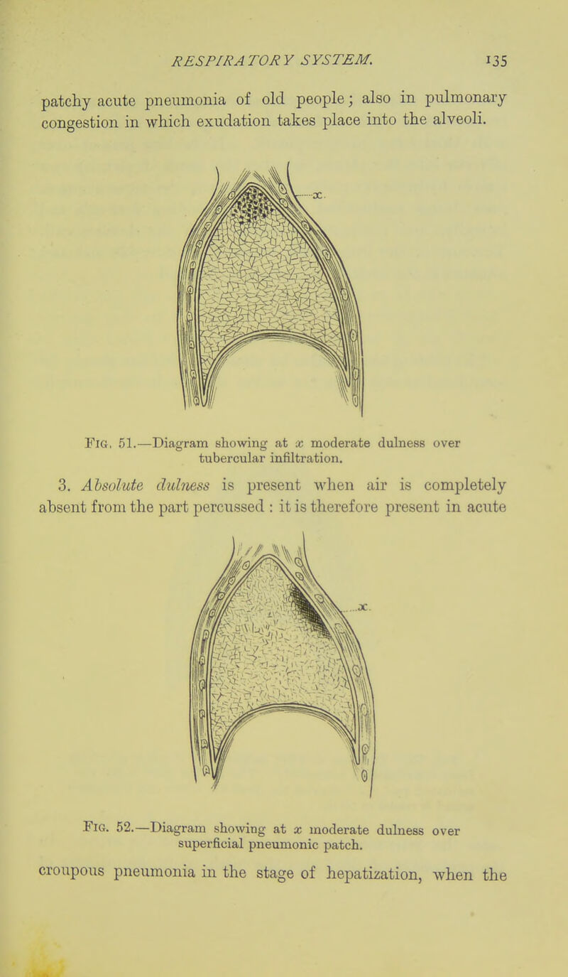 patchy acute pneumonia of old people; also in pulmonary congestion in which exudation takes place into the alveoli. Fig, 51.—Diagram showing at x moderate dulness over tubercular infiltration. 3. Absolute dulness is present M'hen air is completely absent from the part percussed : it is therefore present in acute Fig. 52.—Diagram showing at x moderate dulness over superficial pneumonic jjatch. croupous pneumonia in the stage of hepatization, when the