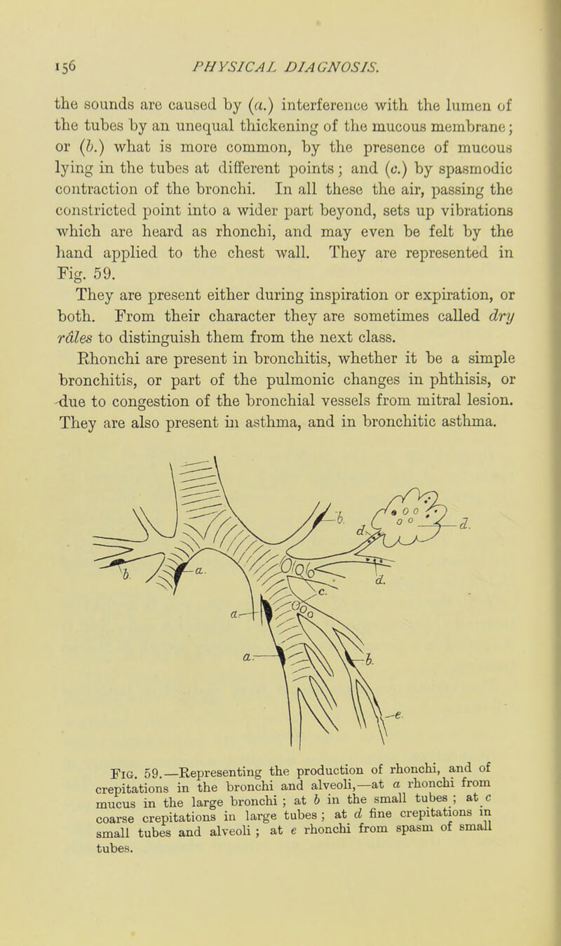 the sounds are caused by («.) interference with the lumen of the tubes by an unequal thickening of the mucous membrane; or (Z^.) what is more common, by the presence of mucous lying in the tubes at different points; and {c.) by spasmodic contraction of the bronchi. In all these the air, passing the constricted point into a wider part beyond, sets up vibrations which are heard as rhonchi, and may even be felt by the hand applied to the chest wall. They are represented in Fig. 59. They are present either during inspiration or expiration, or both. From their character they are sometimes called dry rales to distinguish them from the next class. Rhonchi are present in bronchitis, whether it be a simple bronchitis, or part of the pulmonic changes in phthisis, or -due to congestion of the bronchial vessels from mitral lesion. They are also present in asthma, and in bronchitic asthma. Fig 59.—Representing the production of rhonchi, and of crepitations in the bronchi and alveoli,—at a rhonchi from mucus in the large bronchi ; at 6 in the small tubes ; at c coarse crepitations in large tubes ; at d fine crepitations in small tubes and alveoli ; at e rhonchi from spasm of small tubes.