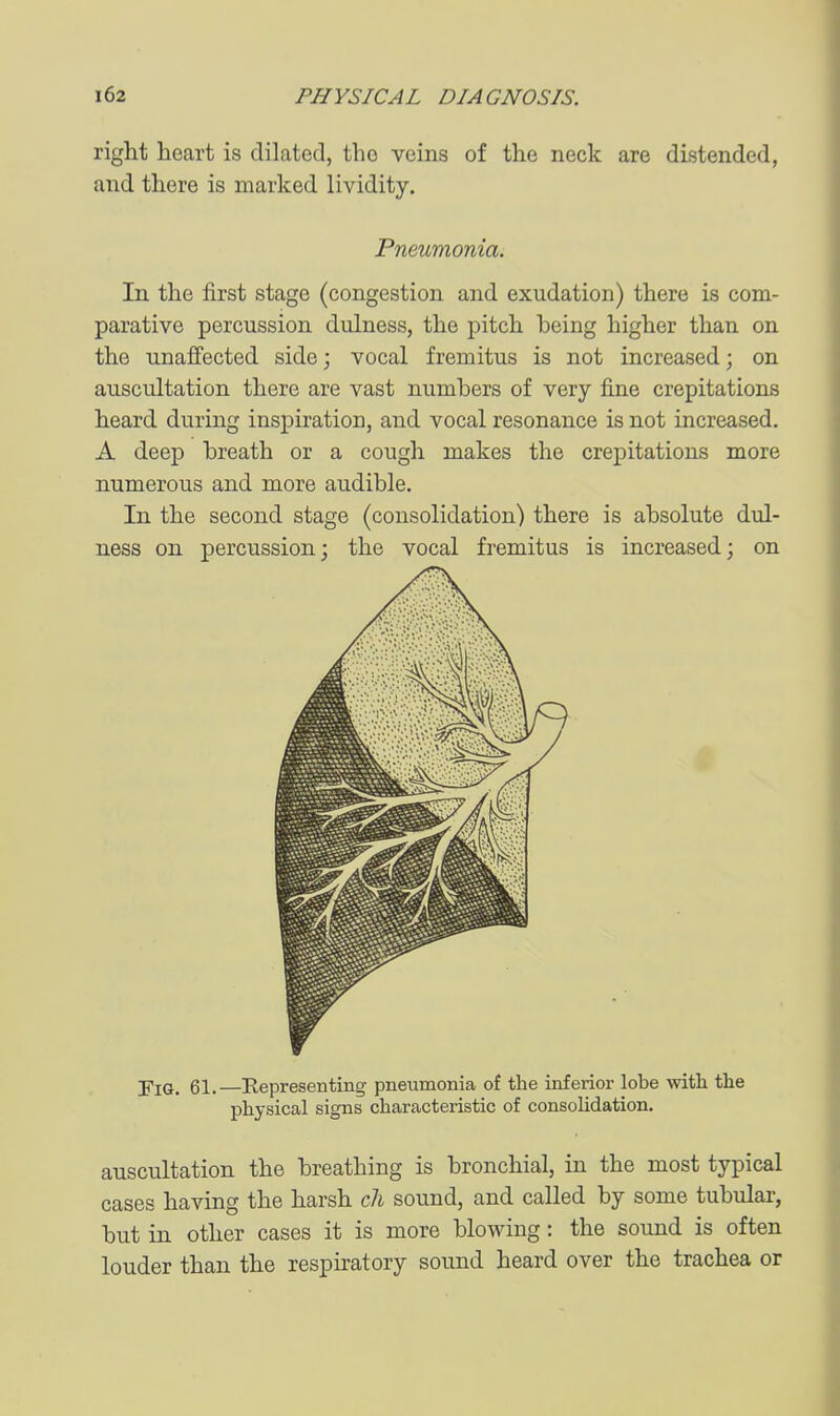 right heart is dilated, the veins of the neck are distended, and there is marked lividity. Pneumonia. In the first stage (congestion and exudation) there is com- parative percussion dulness, the pitch being higher than on the unaffected side; vocal fremitus is not increased; on auscultation there are vast numbers of very fine crepitations heard during inspiration, and vocal resonance is not increased. A deep breath or a cough makes the crepitations more numerous and more audible. In the second stage (consolidation) there is absolute dul- ness on percussion; the vocal fremitus is increased; on Fig. 61.—Representing pneumonia of the inferior lobe with the physical signs characteristic of consolidation, auscultation the breathing is bronchial, in the most typical cases having the harsh cli sound, and called by some tubular, but in other cases it is more blowing: the sound is often louder than the respiratory sound heard over the trachea or