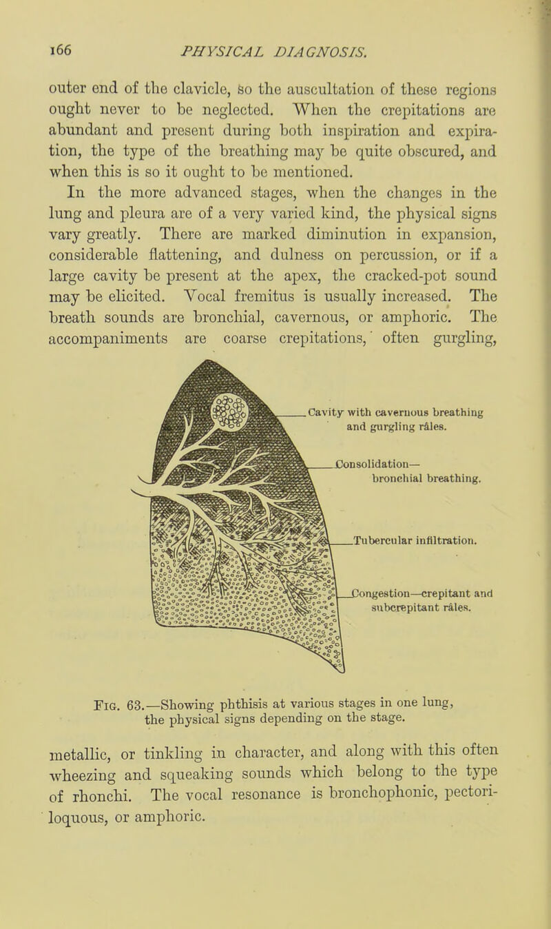outer end of the clavicle, So the auscultation of these regions ought never to be neglected. When the crepitations are abundant and present during both inspiration and expira- tion, the type of the breathing may be quite obscured, and when this is so it ought to be mentioned. In the more advanced stages, when the changes in the lung and pleura are of a very varied kind, the physical signs vary greatly. There are marked diminution in expansion, considerable flattening, and dulness on percussion, or if a large cavity be present at the apex, the cracked-pot sound may be elicited. Vocal fremitus is usually increased. The breath sounds are bronchial, cavernous, or amphoric. The accompaniments are coarse crepitations,' often gurgling, Cavity with caveruuus breathing and gurgling r&les. !onsolidation— bronchial breathing. Tubercular infiltration. iongestion—crepitant and snbcrepitant rales. Fig. 63.—Showing phthisis at various stages in one lung, the physical signs depending on the stage. metallic, or tinkling in character, and along with this often wheezing and squeaking sounds which belong to the type of rhonchi. The vocal resonance is bronchophonic, pectori- loquous, or amphoric.