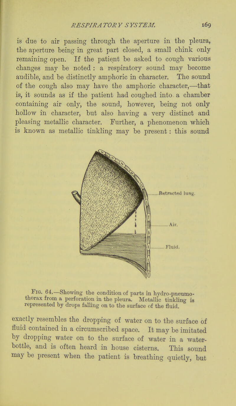 is due to air passing through the aperture in the pleura, the aperture being in great part closed, a small chink only remaining open. If the patient be asked to cough various changes may be noted : a respiratory sound may become audible, and be distinctly amphoric in character. The sound of the cough also may have the amphoric character,—that is, it sounds as if the patient had coughed into a chamber containing air only, the sound, however, being not only hollow in character, but also having a very distinct and pleasing metallic character. Further, a phenomenon which is known as metallic tinkling may be present : this sound BetrHoted lung. Air. _ riuid. Fig. 64.—Showing the condition of parts in hydro-pneumo- thorax from a perforation in the pleura. Metallic tinkling is represented by drops falling on to the surface of the fluid. exactly resembles the dropping of water on to the surface of fluid contained in a circumscribed space. It may be imitated by dropping water on to the surface of water in a water- bottle, and is often heard in house cisterns. This sound may be present when the patient is breathing quietly, but
