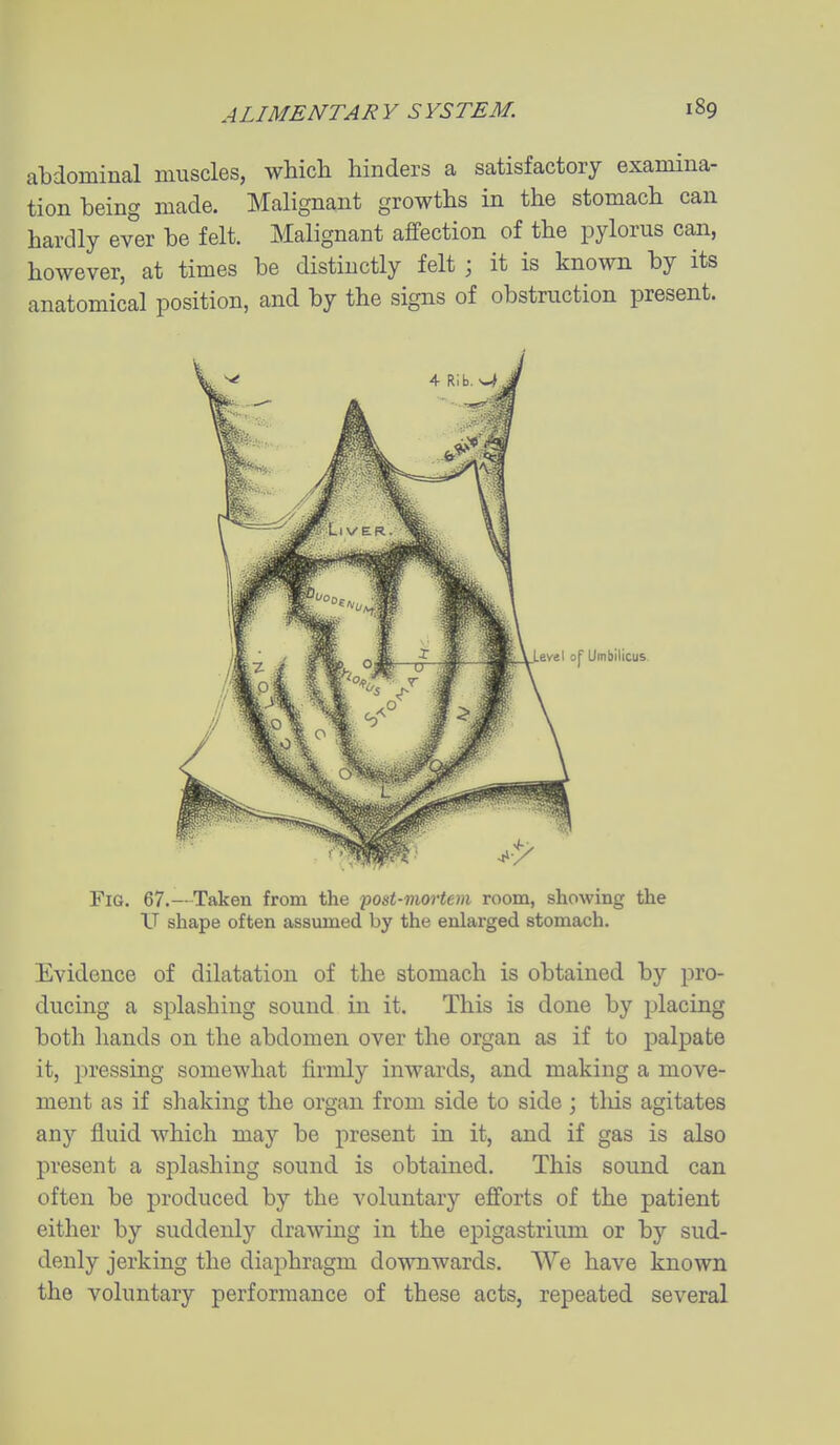 abdominal muscles, which hinders a satisfactory examina- tion being made. Malignant growths in the stomach can hardly ever be felt. Malignant affection of the pylorus can, however, at times be distinctly felt ; it is known by its anatomical position, and by the signs of obstruction present. Fig. 67.—Taken from the post-moi'tem room, showing the U shape often assumed by the enlarged stomach. Evidence of dilatation of the stomach is obtained by pro- ducing a splashing sound in it. This is done by placing both hands on the abdomen over the organ as if to palpate it, pressing somewhat firmly inwards, and making a move- ment as if shaking the organ from side to side ; this agitates any fluid which may be present in it, and if gas is also present a splashing sound is obtained. This sound can often be produced by the voluntary efforts of the patient either by suddenly drawing in the epigastrium or by sud- denly jerking the diaphragm downwards. We have known the voluntary performance of these acts, repeated several Level of Umbilicus.