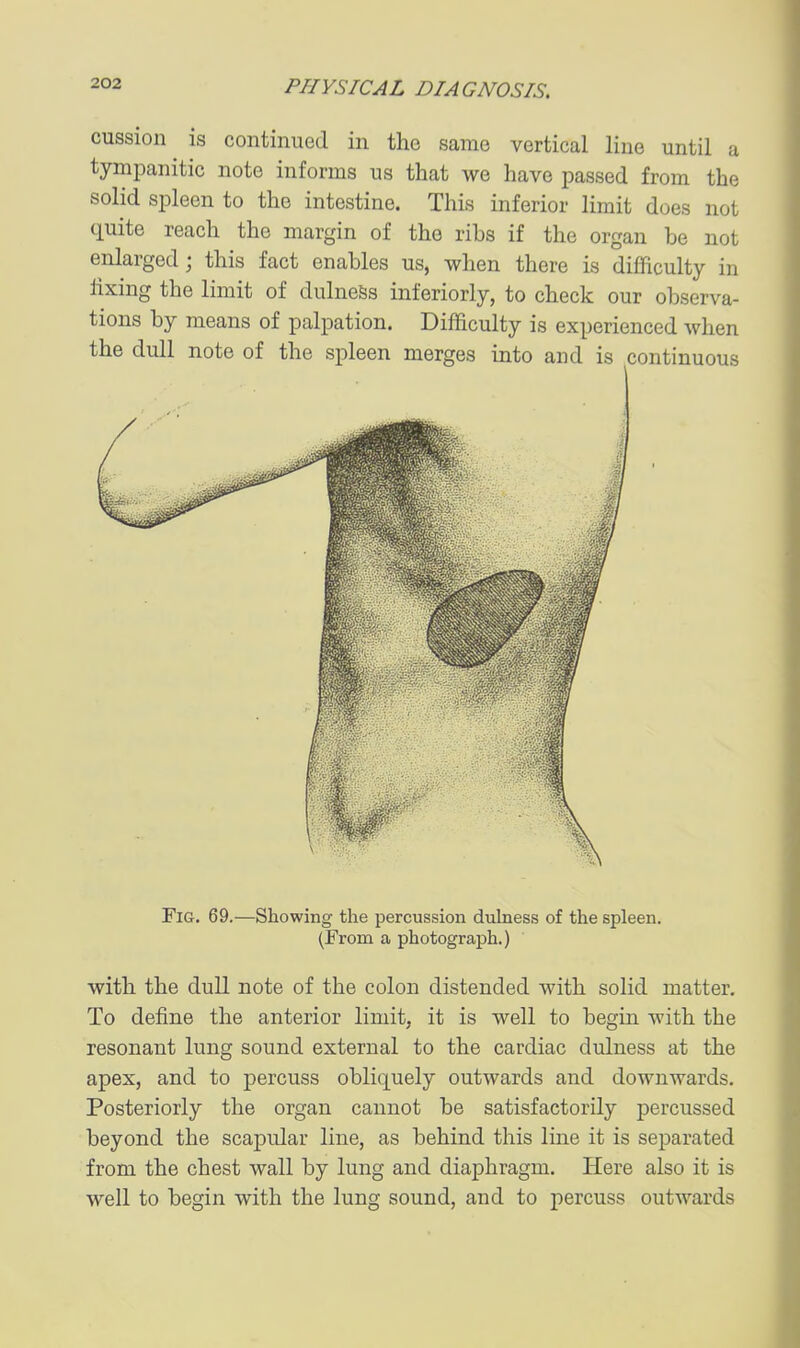 cussion is continued in the same vertical line until a tympanitic note informs us that we have passed from the solid spleen to the intestine. This inferior limit does not quite reach the margin of the ribs if the organ be not enlarged; this fact enables us, when there is difficulty in fixing the limit of dulnefes interiorly, to check our observa- tions by means of palpation. Difficulty is experienced Avhen the dull note of the spleen merges into and is continuous Fig. 69.—Showing the percussion dulness of the spleen. (From a photograph.) with the dull note of the colon distended with solid matter. To define the anterior limit, it is well to begin with the resonant lung sound external to the cardiac dulness at the apex, and to percuss obliquely outwards and downwards. Posteriorly the organ cannot be satisfactorily percussed beyond the scapular line, as behind this line it is separated from the chest wall by lung and diaphragm. Here also it is well to begin with the lung sound, and to percuss outwards