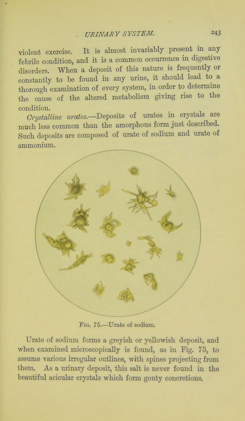 violent exercise. It is almost invariably present m any febrile condition, and it is a common occurrence in digestive disorders. When a deposit of this nature is frequently or constantly to be found in any urine, it should lead to a thorough examination of every system, in order to determine the cause of the altered metabolism giving rise to the condition. Crystalline ?tr-a^es.—Deposits of urates in crystals are much less common than the amorphous form just described. Such deposits are composed of urate of sodium and urate of ammonium. Fig. 75.—Urate of sodium. Urate of sodium forms a greyish or yellowish deposit, and when examined microscopically is found, as in Fig. 75, to assume various irregular outlines, with spines projecting from them. As a urinary deposit, this salt is never found in the beautiful acicular crystals which form gouty concretions.