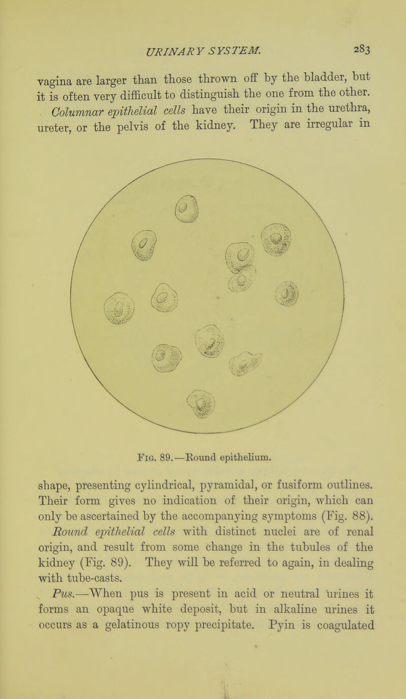 vagina are larger than those thrown off by the bladder, but it is often very difficult to distinguish the one from the other. Columnar epithelial cells have their origin in the urethra, ureter, or the pelvis of the kidney. They are irregular in Fig. 89.—Round epithelium. shape, presenting cylindrical, pyramidal, or fusiform outlines. Their form gives no indication of their origin, which can only be ascertained by the accompanying symptoms (Fig. 88). Round epithelial cells with distinct nuclei are of renal origin, and result from some change in the tubules of the kidney (Fig. 89). They will be referred to again, in dealing with tube-casts. , Pus.—When pus is present in acid or neutral urines it forms an opaque white deposit, but in alkaline urines it occurs as a gelatinous ropy precipitate. Pyin is coagulated