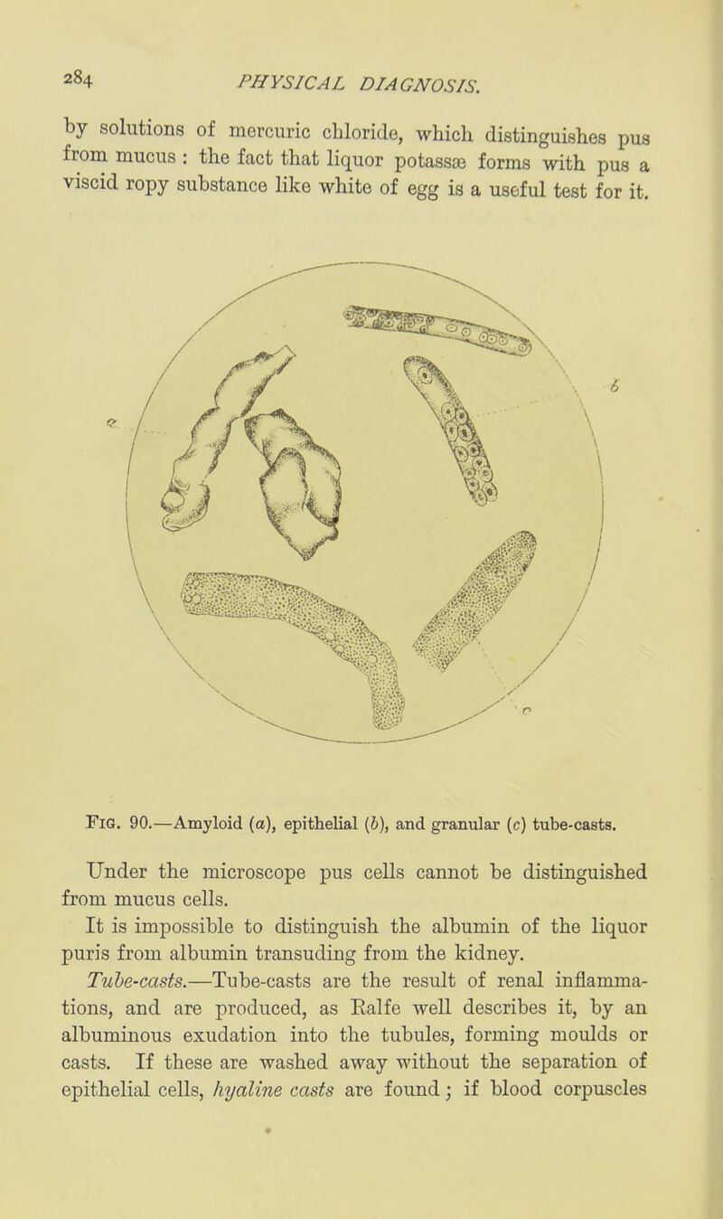 by solutions of mercuric chloride, which distinguishes pus from mucus : the fact that liquor potasste forms with pus a viscid ropy substance like white of egg is a useful test for it. Fig. 90.—Amyloid (a), epithelial (6), and granular (c) tube-casts. Under the microscope pus cells cannot be distinguished from mucus cells. It is impossible to distinguish the albumin of the liquor puris from albumin transuding from the kidney. Tube-casts.—Tube-casts are the result of renal inflamma- tions, and are produced, as Ealfe well describes it, by an albuminous exudation into the tubules, forming moulds or casts. If these are washed away without the separation of epithelial cells, hyaline casts are found; if blood corpuscles