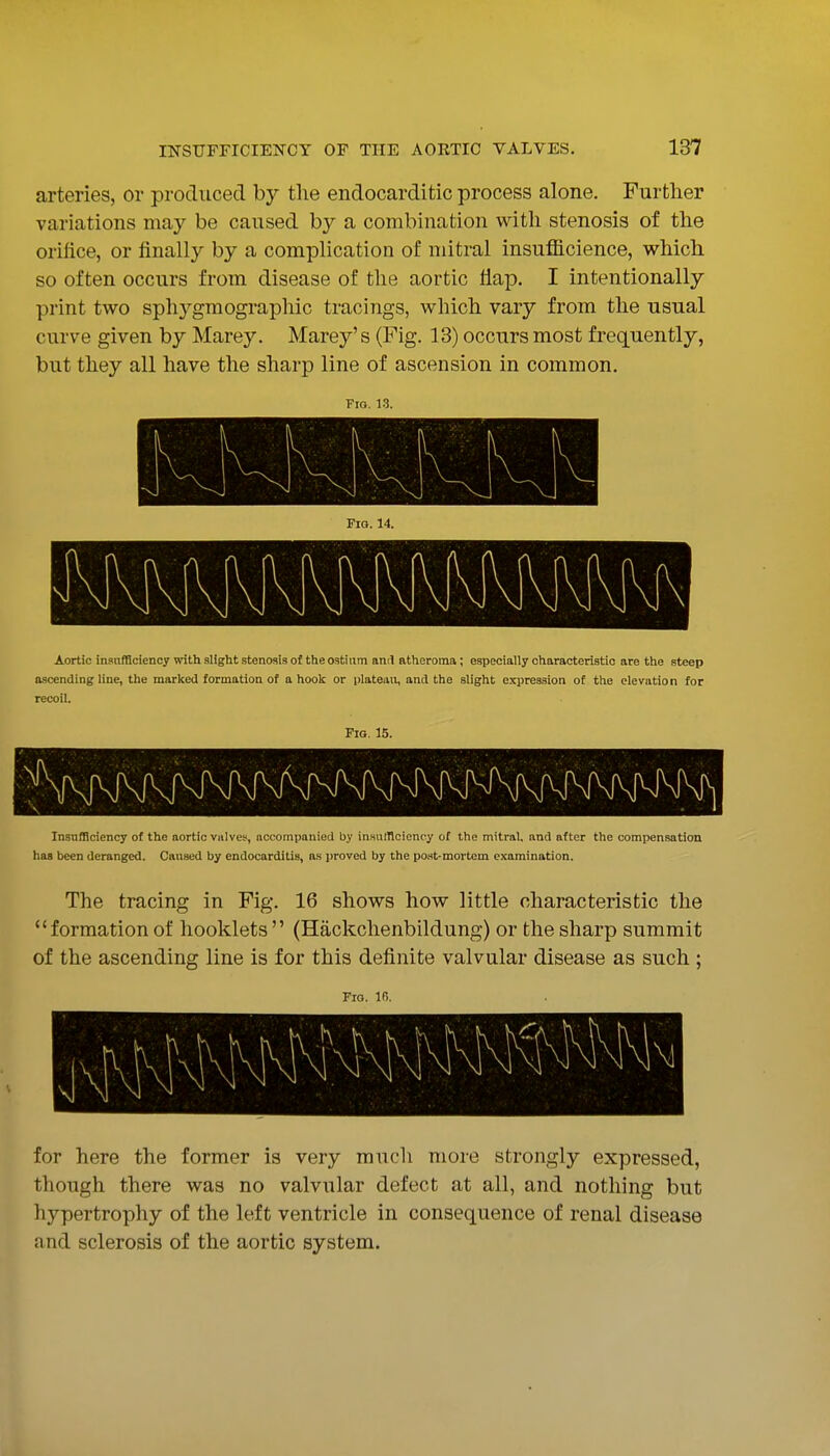 arteries, or produced by the endocarditic process alone. Further variations may be caused by a combination with stenosis of the orifice, or finally by a complication of mitral insufficience, which so often occurs from disease of the aortic flap. I intentionally print two sphygmographic tracings, which vary from the usual curve given by Marey. Marey's (Fig. 18) occurs most frequently, but they all have the sharp line of ascension in common. Fig. 13. Aortic insnfficiency with slight stenosis of the ostium anil atheroma; especially characteristic are the steep ascending line, the marked formation of a hook or platemi, and the slight expression of the elevation for recoil. Fio. 15. Insufficiency of the aortic valves, accompanied by inHUlIlciency of the mitral, and after the compensation has been deranged. Caused by endocarditis, as proved by the post-mortem examination. The tracing in Fig. 16 shows how little characteristic the formation of hooklets  (Hackchenbildung) or the sharp summit of the ascending line is for this definite valvular disease as such ; Fro. Ifi. for here the former is very much more strongly expressed, though there was no valvular defect at all, and nothing but hypertrophy of the left ventricle in consequence of renal disease and sclerosis of the aortic system.