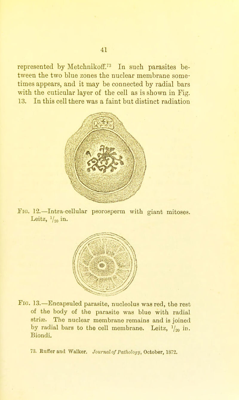 represented by MetchnikofF. In such parasites be- tween the two blue zones the nuclear membrane some- times appears, and it may be connected by radial bars with the cuticular layer of the cell as is shown in Fig. 13. In this cell there was a faint but distinct radiation Fig. 13.—Encapsuled parasite, nucleolus was red, the rest of the body of the parasite was blue with radial striae. The nuclear membrane remains and is joined by radial bars to the cell membrane. Leitz, V20 i. Biondi. 73. Eufferand Walker. Journalof Pathology, October, 1872.