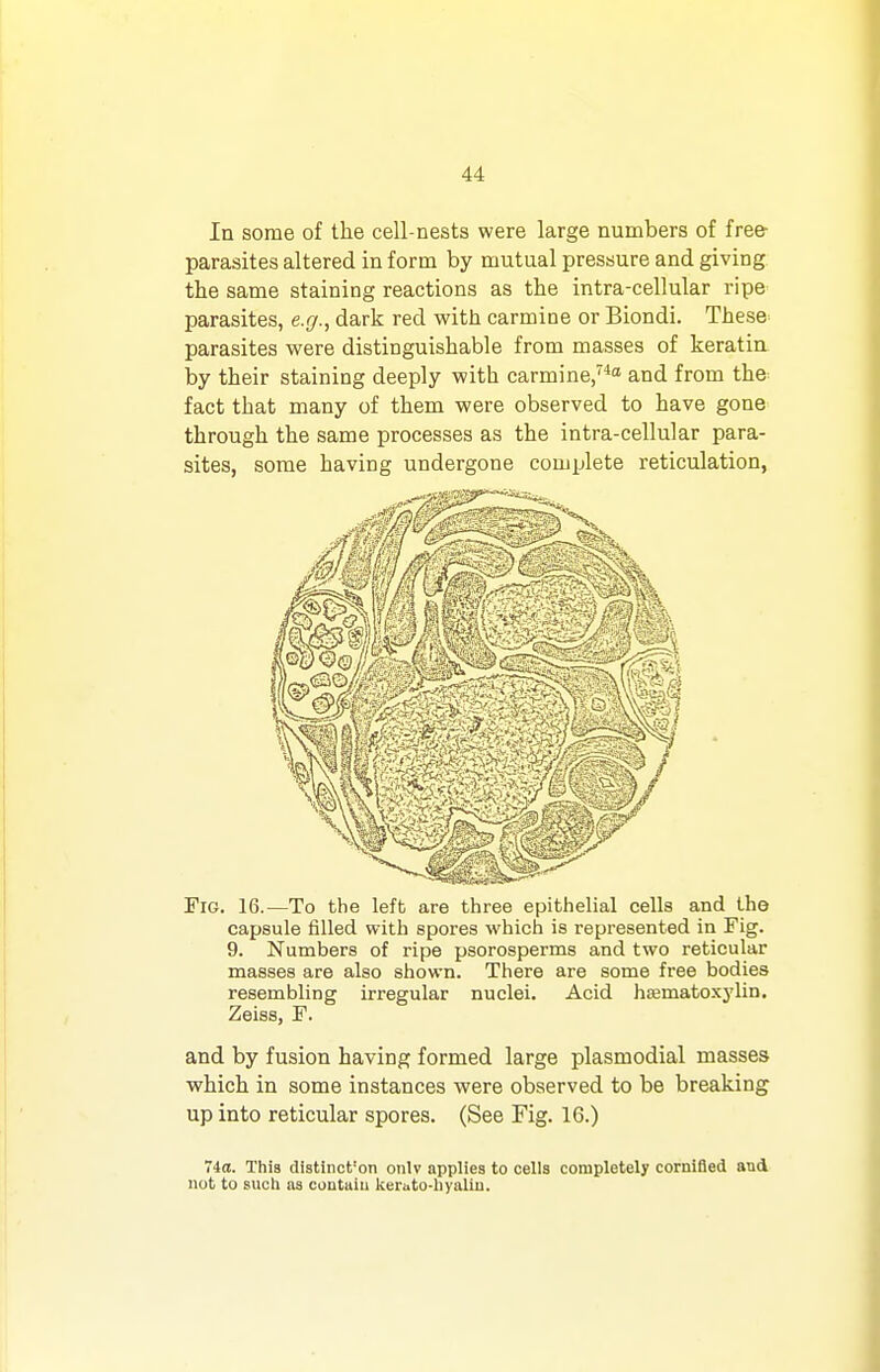 In some of the cell-nests were large numbers of free- parasites altered in form by mutual pressure and giving the same staining reactions as the intra-cellular ripe parasites, e.g., dark red with carmine or Biondi. These parasites were distinguishable from masses of keratia by their staining deeply with carmine/^'' and from the fact that many of them were observed to have gone through the same processes as the intra-cellular para- sites, some having undergone complete reticulation, Fig. 16.—To the left are three epithelial cells and the capsule filled with spores which is represented in Fig. 9. Numbers of ripe psorosperms and two reticular masses are also shown. There are some free bodies resembling irregular nuclei. Acid hEematoxylin. Zeiss, F. and by fusion having formed large plasmodial masses which in some instances were observed to be breaking up into reticular spores. (See Fig. 16.) 740. This diatinct'on onlv applies to cells completely cornifled and not to such na contaiu kerato-liyalin.