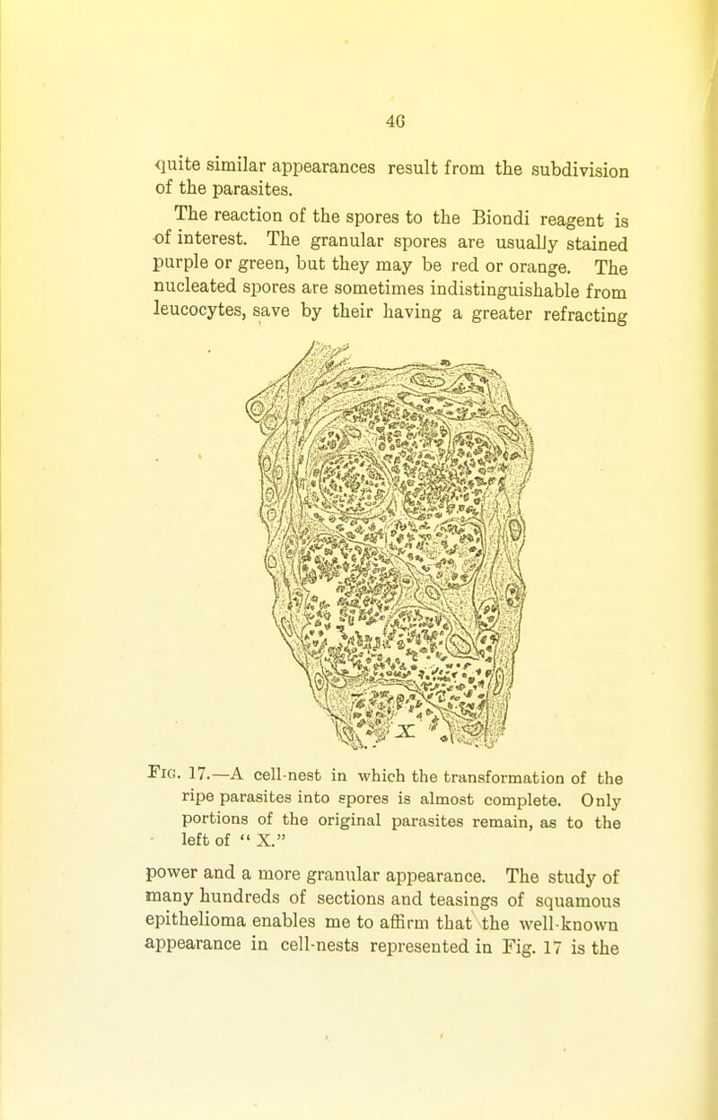 4G quite similar appearances result from the subdivision of the parasites. The reaction of the spores to the Biondi reagent is of interest. The granular spores are usually stained purple or green, but they may be red or orange. The nucleated spores are sometimes indistinguishable from leucocytes, save by their having a greater refracting Fig. 17.—a cell-nesb in which the transformation of the ripe parasites into epores is almost complete. Only portions of the original parasites remain, as to the - left of X. power and a more granular appearance. The study of many hundreds of sections and teasings of squamous epithelioma enables me to affirm that the well-known appearance in cell-nests represented in Fig. 17 is the