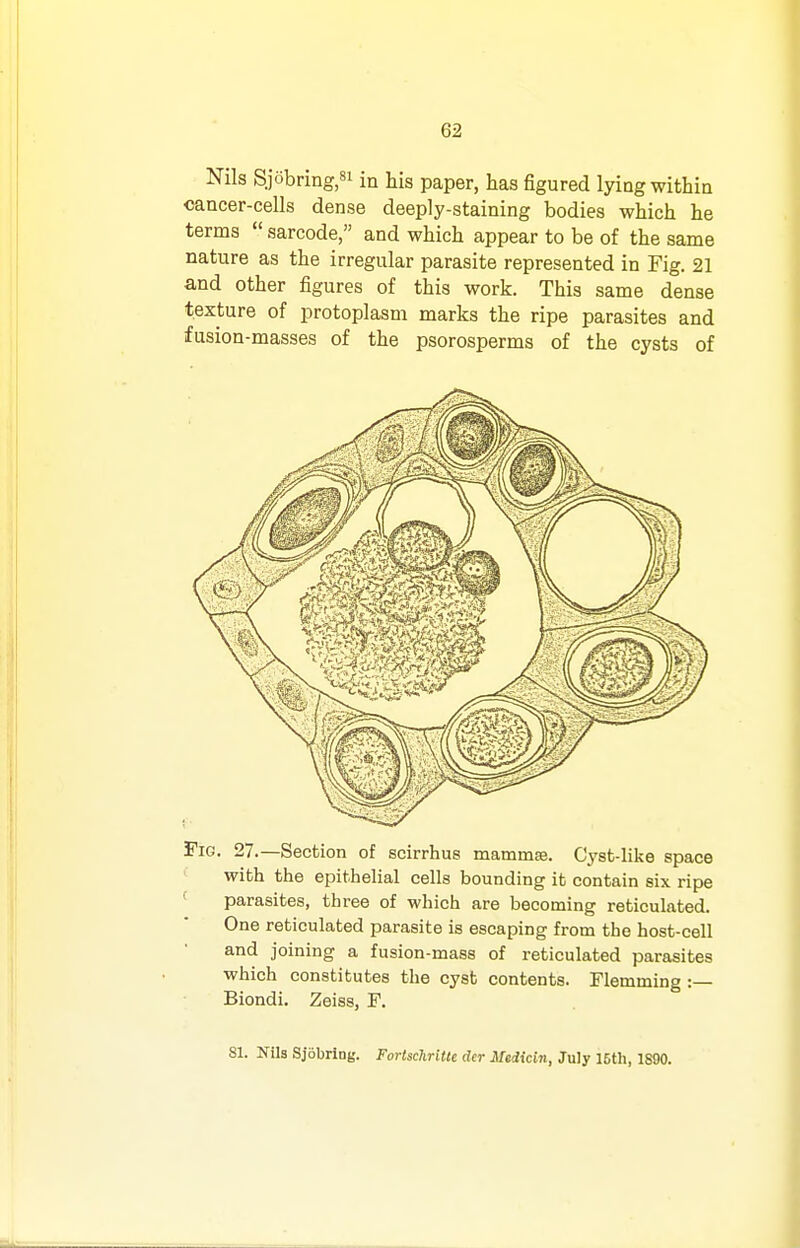 Nils Sjobriiig,8i in his paper, has figured lying within cancer-cells dense deeply-staining bodies which he terms  sarcode, and which appear to be of the same nature as the irregular parasite represented in Fig. 21 and other figures of this work. This same dense texture of protoplasm marks the ripe parasites and fusion-masses of the psorosperms of the cysts of I'iG. 27.—Section of scirrhue mammse. Cyst-like space with the epithelial cells bounding it contain six ripe ' parasites, three of which are becoming reticulated. One reticulated parasite is escaping from the host-cell and joining a fusion-mass of reticulated parasites which constitutes the cyst contents. Flemming :— Biondi. Zeiss, F. 81. Nils Sjbbrlng. Fortschritte der Medicin, July 15th, 1890.