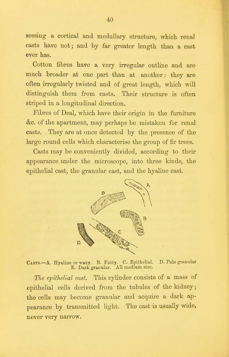 sessing a cortical and medullary structure^ which renal casts have not; and by far greater length than a cast ever has. Cotton fibres have a very irregular outline and are much broader at one part than at another: they are often irregularly twisted and of great length, which will distinguish them from casts. Their structure is often striped in a longitudinal direction. Fibres of Deal, which have their origin in the furniture &c. of the apartment, may perhaps be mistaken for renal casts. They are at once detected by the presence of the large round cells which characterise the group of fir trees. Casts may be conveniently divided, according to their appearance under the microscope, into three kinds, the epithelial cast, the granular cast, and the hyaline cast. Casts.—A. Hyaline or wa^y. B. Fatty. C Epittelial. D. Pale granular E. Dark granular. All medium size. The epithelial cast. This cylinder consists of a mass of epithelial cells derived from the tubules of the kidney; the cells may become granular and acquire a dark ap- pearance by transmitted light. The cast is usually wide, never very narrow.
