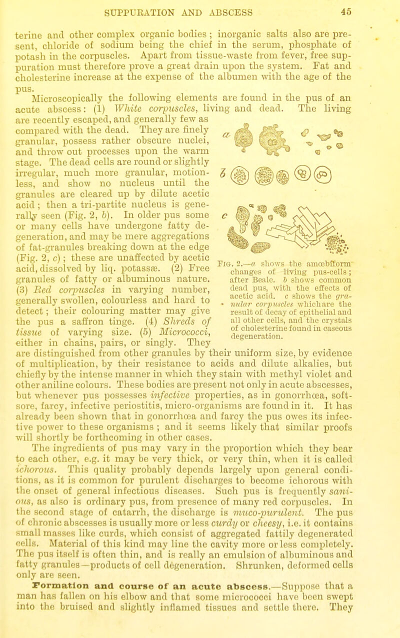 terine and other complex organic bodies ; inorganic salts also are pre- sent, chloride of sodium being the chief in the serum, phosphate of potash in the corpuscles. Apart from tissue-waste from fever, free sup- puration must therefore prove a great drain upon the system. Fat and cholesterine increase at the expense of the albumen with the age of the pus. Microscopically the following elements are found in the pus of an acute abscess: (1) White corpuscles, living and dead. The living are recently escaped, and generally few as compared with the dead. They are finely granular, possess rather obscure nuclei, and throw out processes upon the warm stage. The dead cells are round or slightly irregular, much more granular, motion- less, and show no nucleus until the granules are cleared up by dilute acetic acid ; then a tri-partite nucleus is gene- rally seen (Fig. 2, 6). In older pus some or many cells have undergone fatty de- generation, and may be mere aggregations of fat-granules breaking down at the edge (Fig. 2, c); these are unaffected by acetic acid, dissolved by liq. potassfB. (2) Free granules of fatty or albuminous nature. (.3) Bed cotjmscles in varying number, generally swollen, colourless and hard to detect; their colouring matter may give the pus a saffron tinge. (4) Shreds of tissue of varying size. (5) Micrococci, either in chains, pairs, or singly. They are distinguished from other granules by their uniform size, by evidence of multiplication, by their resistance to acids and dilute alkalies, but chiefly by the intense manner in which they stain with methyl violet and other aniline colours. These bodies are present not only in acute abscesses, but whenever pus possesses infective properties, as in gonorrhoea, soft- sore, farcy, infective periostitis, micro-organisms are found in it. It has ah-eady been shown that in gonorrhoea and farcy the pus owes its infec- tive power to these organisms ; and it seems likely that similar proofs will shortly be forthcoming in other cases. The ingredients of pus may vary in the proportion which they bear to each other, e.g. it may be very thick, or very thin, when it is called ichorous. This quality probably depends largely upon general condi- tions, as it is common for purulent discharges to become ichorous with the onset of general infectious diseases. Such pus is frequently sani- ous, as also is ordinary pus, from presence of many red corpuscles. In the second stage of catarrh, the discharge is muco-imrulent. The pus of chronic abscesses is usually more or less curdy or cheesy, i.e. it contains small masses like curds, which consist of aggregated fattily degenerated cells. Material of this kind may line the cavity more or less completely. The pus itself is often thin, and is really an emulsion of albuminous and fatty granules—products of cell degeneration. Shrunken, deformed cells only are seen. Formation and course of an acute abscess.—Suppose that a man has fallen on his elbow and that some micrococci have been swept into the bruised and slightly inflamed tissues and settle there. They Fig. 2.—a sliows the amaBbiform changes of living pus-cells; after Beale. b shows common dearl pus, with the effects of acetic acid, c shows the gra- • nnlur corpuscles which are the result of decay of epithelial and all other cells, and the crystals of cholesterine found in caseous degeneration.