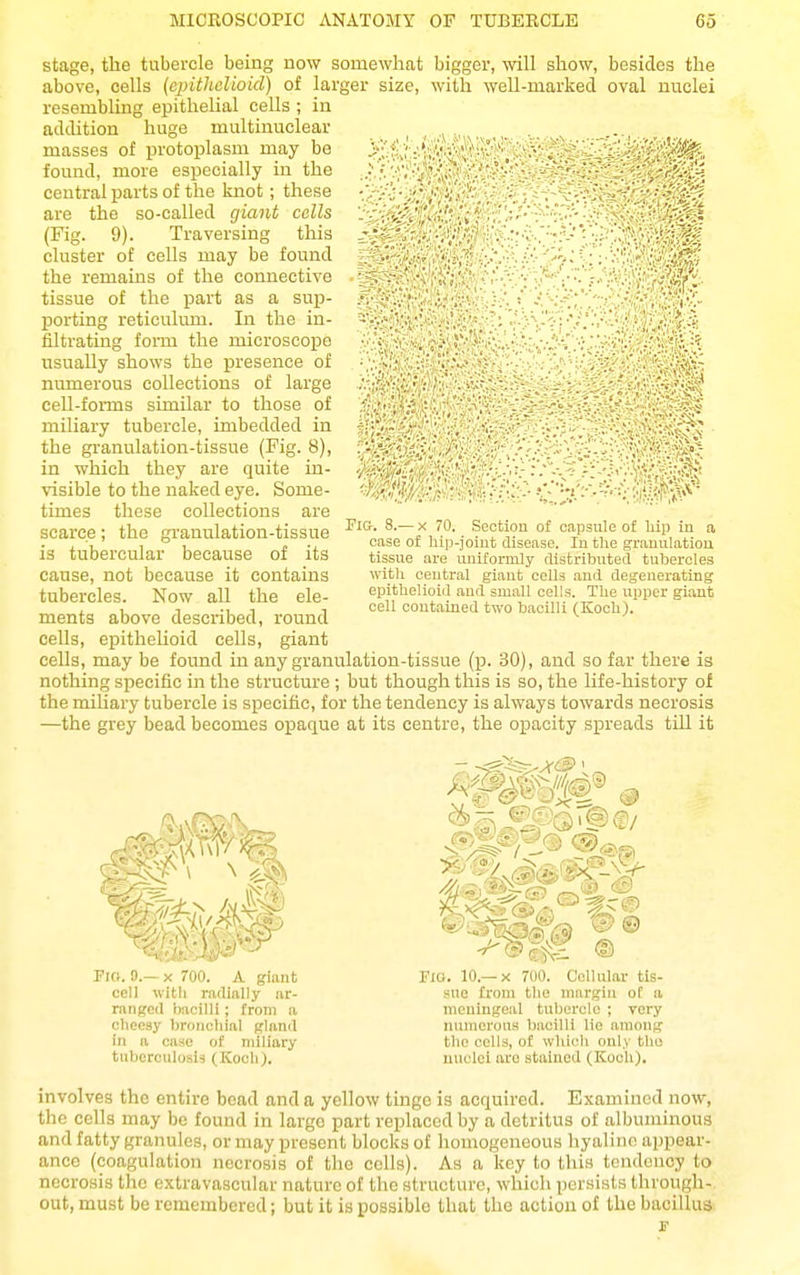 stage, the tubercle being now somewhat bigger, will show, besides the above, cells (cpitlidioid) of larger size, witla well-marked oval nuclei resembling epithelial cells ; in addition huge multinuelear masses of protoplasm may be found, more especially in the central parts of the Imot; these are the so-called giant cells (Fig. 9). Traversing this cluster of cells may be found the remains of the connective tissue of the part as a sup- porting reticulum. In the in- filtrating foiTU the microscope usually shows the presence of numerous collections of large cell-forms similar to those of miliary tubercle, imbedded in the granulation-tissue (Fig. 8), in which they are quite in- visible to the naked eye. Some- times these collections are scarce; the granulation-tissue is tubercular because of its cause, not because it contains tubercles. Now all the ele- ments above described, round cells, epithelioid cells, giant cells, may be found in any granulation-tissue (p. 30), and so far there is nothing specific in the structure ; but though this is so, the life-history of the miUary tubercle is specific, for the tendency is always towards necrosis —the grey bead becomes opaque at its centre, the opacity spreads till it ''■mm '■'■•.Mr Pig. 8.— X 70. Section of capsule of hip in a case of lup-joiut disease. In tlie grauulatloa tissue are uniformly rlistributed tubercles with central giant cells and degenerating epithelioid and small cells. The upper giant cell contained two bacilli (Koch). mm Fio. 9.— X 700. A giant cell with radially ar- ranged bacilli; from a choosy bronchial gland in a case of miliary tuberculosis (Kooli). Fig. 10.—X 700. Cellular tis- sue from the margin of a meningeal tuljerolo ; very numerous bacilli lie among the cells, of whicli only tliu nuclei are stained (Koch). involves the entire bead and a yellow tinge is acquired. Examined now, the cells may be found in large part replaced by a detritus of albuminous and fatty granules, or may present blocks of homogeneous hyaline appear- ance (coagulation necrosis of the cells). As a key to this tendency to necrosis the extra vascular nature of the structure, which persists through- out, must be remembered; but it is possible that the action of the bacillus