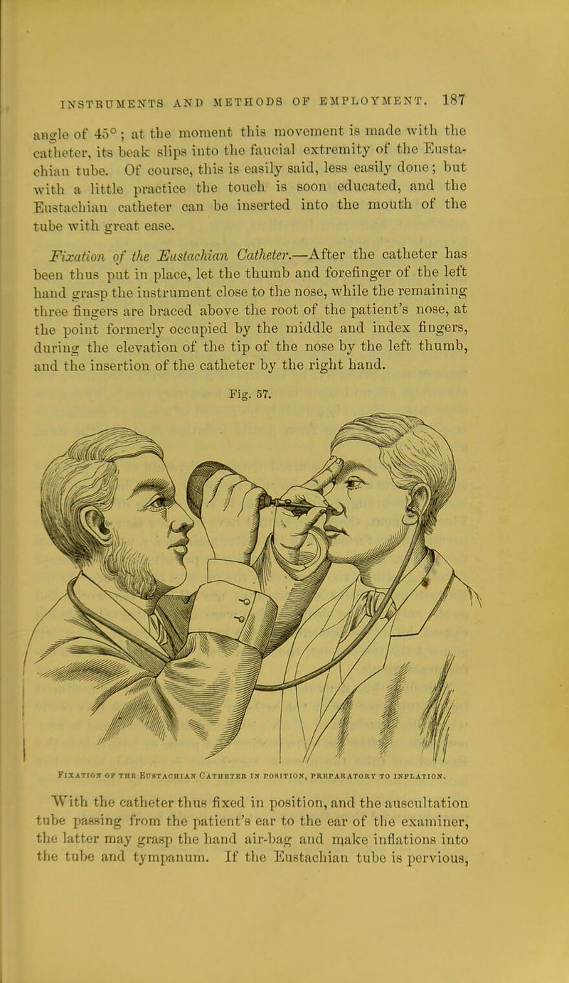 aHo;le of 45° ; at the moment this movement is made with the catheter, its beak slips into the faucial extremity of the Eusta- chian tube. Of course, this is easily said, less easily done; but with a little practice the touch is soon educated, and the Eustachian catheter can be inserted into the mouth of the tube with great ease. Fixation of the Eustachian Catheter.—Aiiev the catheter has been thus put in place, let the thumb and forefinger of the left hand grasp the instrument close to the nose, while the remaining three fingers are braced above the root of the patient's nose, at the point formerly occupied by the middle and index fingers, during the elevation of the tip of the nose by the left thumb, and the insertion of the catheter by the right hand. Fig. 57. Fixation op the Eitbtachiax Cathetee i» position, preparatobt to inflatiok. With the catheter thus fixed in position, and the auscultation tube passing from the patient's ear to the ear of the examiner, the latter may grasp the hand air-bag and n^ake inflations into the tube and tympanum. If the Eustachian tube is pervious,