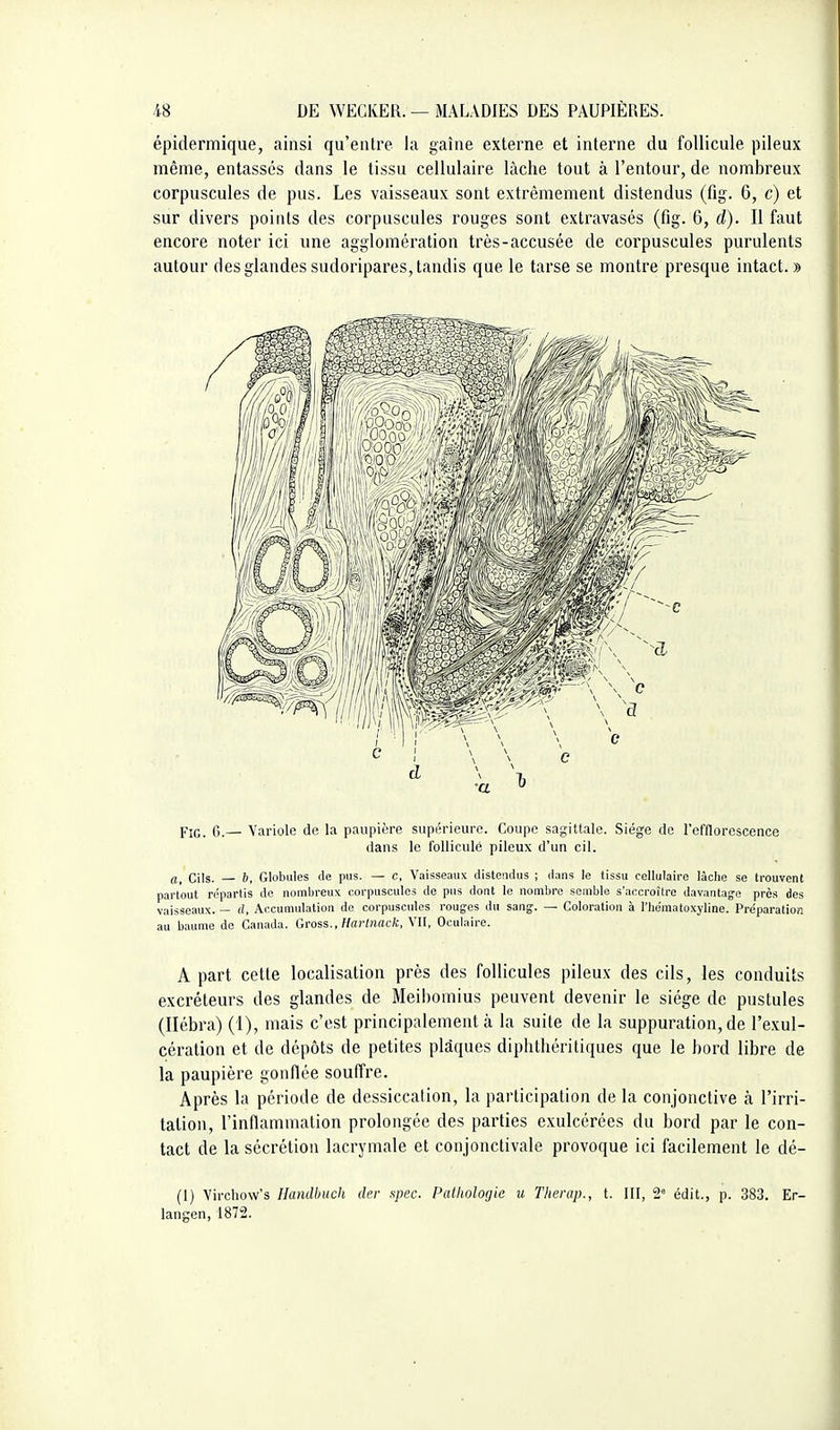 épidermique, ainsi qu'entre la gaîne externe et interne du follicule pileux même, entassés dans le tissu cellulaire lâche tout à l'entour, de nombreux corpuscules de pus. Les vaisseaux sont extrêmement distendus (fig. 6, c) et sur divers points des corpuscules rouges sont extravasés (fig. 6, d). Il faut encore noter ici une agglomération très-accusée de corpuscules purulents autour des glandes sudoripares, tandis que le tarse se montre presque intact. » Pjc_ c,— Variole de la paupière supérieure. Coupe sagittale. Siège de l'cfllorescence dans le follicule pileux d'un cil. a, Cils. — 6, Globules de pus. — c, Vaisseaux distendus ; dans le tissu cellulaire lâche se trouvent partout répartis de nombreux corpuscules de pus dont le nombre semble s'accroître davantage près des vaisseaux. — d, Accumulation de corpuscules rouges du sang'. — Coloration à l'Iiématoxyline. Préparation au baume de Canada. Gross., HaHnack,\U, Oculaire. A part cette localisation près des follicules pileux des cils, les conduits excréteurs des glandes de Meihomius peuvent devenir le siège de pustules (Ilébra) (1), mais c'est principalement à la suite de la suppuration, de l'exul- cération et de dépôts de petites plâques diphthèritiques que le bord libre de la paupière gonflée souffre. Après la période de dessiccation, la participation de la conjonctive tà l'irri- tation, l'inflammation prolongée des parties exulcérées du bord par le con- tact de la sécrétion lacrymale et conjonctivale provoque ici facilement le dé- (1) Virchow's llamlhuch der spec. Pailwlogie u Therap., t. 111, 2 édit., p. 383. Er- langen, 1872.