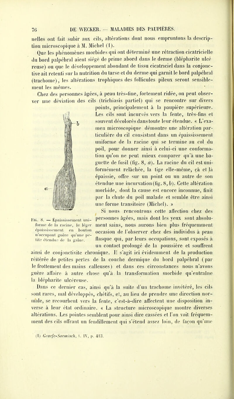 nelles ont fait subir aux cils, altérations dont nous empruntons la descrip- tion microscopique à M. Michel (1). Que les phénomènes morbides qui ont déterminé une rétraction cicatricielle du bord palpébral aient siégé de prime abord dans le derme (blépharite ulcé reuse) ou que le développement abondant de tissu cicatriciel dans la conjonc- tive ait retenti sur la nutrition du tarse et du derme qui garnit le bord palpébral (trachome), les altérations trophiques des follicules pileux seront sensible- ment les mêmes. Chez des personnes âgées, à peau très-fine, fortement ridée, on peut obser- ver une déviation des cils (trichiasis partiel) qui se rencontre sur divers points, principalement à la paupière supérieure. Les cils sont incurvés vers la fente, très-fins et souvent décolorés dans toute leur étendue. « L'exa- men microscopique démontre une altération par- ticulière du cil consistant dans un épaississemeiit uniforme de la racine qui se termine au col du poil, pour donner ainsi à celui-ci une conforma- tion qu'on ne peut mieux comparer qu'à une ba- guette de fusil (fig. 8, a). La racine du cil est uni- formément relâchée, la tige elle-même, fà et là épaissie, offre sur un point ou un autre de son étendue une incurvation(fig. 8, b). Cette altération morbide, dont la cause est encore inconnue, finit par la chute du poil malade et semble être ainsi une, forme transitoire (Michel). » Si nous rencontrons cette affection chez des personnes âgées, mais dont les yeux sont absolu- ment sains, nous aurons bien plus fréquemment occasion de l'observer chez des individus à peau flasque qui, par leurs occupations, sont exposés à un contact prolongé de la poussière et souffrent ainsi de conjonctivite chronique. Il s'agit ici évidemment de la production réitérée de petites pertes de la couche dermi(iue du bord palpébral ( par le frottement des mains calleuses) et dans ces circonstances nous n'avons guère affaire à autre chose qu'à la transformation morbide qu'entraîne la blépharite ulcéreuse. Dans ce dernier cas, ainsi qu'à la suite d'un trachome invétéré, les cils sont rares, mal développés, chétifs, et, au lieu de prendre une direction nor- male, se recourbent vers la fente, c'est-à-dire affectent une disposition in- verse à leur état ordinaire. « La structure microscopi(iue montre diverses altérations. Les pointes semblent pour ainsi dire cassées et l'on voit fréquem- ment des cils offrant un fendillement qui s'étend assez loin, de façon qu'une cl Fig. 8. — Épaississcment iini- fornif de la racine, le léger épaississeineiil en bouton n'occupant guère qu'une pe- tite étendui^ de la naîne. (I) (iraefc-Stieiniscli, I. IV, ]>. 41;!.