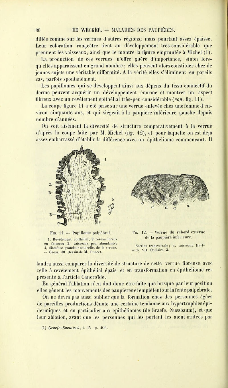 (lillée comme sur les verrues d'autres régions, mais pourtant assez épaisse. Leur coloration rougeâtre lient au développement très-considérable que prennent les vaisseaux, ainsi que le montre la figm'e empruntée à Michel (1). La production de ces verrues n'offre guère d'importance, sinon lors- qu'elles apparaissent en grand nombre ; elles peuvent alors constituer chez de jeunes sujets une véritable difformité. A la vérité elles s'éliminent en pareils cas, parfois spontanément. Les papillomes qui se développent ainsi aux dépens du tissu connectif du derme peuvent acquérir un développement énorme et montrer un aspect fibreux avec un revêtement épithélial très-peu considérable (voy. fig. 11). La coupe figure lia été prise sur une verrue enlevée chez une femme d'en- viron cinquante ans, et qui siégeait à la paupière inférieure gauche depuis nombre d'années. On voit aisément la diversité de structure comparativement à la verrue d'après la coupe faite par M. Michel (fig. 12), et pour laquelle on est déjà assez embarrassé d'établir la différence avec un épithéliome commençant. Il faudra aussi comparer la diversité de structure de cette verrue fibreuse avec celle à revêtement épithélial épais et en transformation en épithéliome re- présenté à l'article Cancroïde. En général l'ablation n'en doit donc être faite que lorsque par leur position elles gênent les mouvements des paupières et empiètent sur la fenlepalpébrale. On ne devra pas aussi oublier que la formation chez des personnes âgées de pareilles productions dénote une certaine tendance aux hypertrophies épi- dermiques et en particulier aux épithéliomes (de Graefe, Nussbaum), et que leur ablation, avant que les personnes qui les portent les aient irritées par I. Revêtement épithélial ; 2, réseau fibreux on faisceau 3, vaisseaux peu ai)ondants ; 4, diamètre grandeuruatnrolle, de la verrue. — Gross. 30. Dessin de M. Poucet. Fig. il. — Papillome palpébral. Fie. 12. — Verrue du ri'bord oxtonic «le la paupière iuférieuro. Section transversale; a, vaisseaux. Hart- uacli, vu. Oculaire, 3.