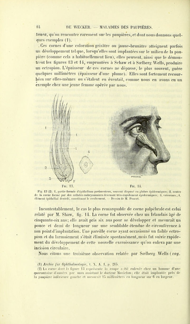 tanpa, qu'on rencontre rarement sur les paupières, et dont nous donnons quel- ques exemples (1). . Ces cornes d'une coloration grisâtre ou jaune-brunâtre atteignent parfois un développement tel que, lorsqu'elles sont implantées sur le milieu de la pau- pière (comme cela a habituellement lieu), elles peuvent, ainsi que le démon- trent les figures 13 et l-l, empruntées à Schaw et cà Sœlberg Wells, produire un ectropion. L'épaisseur de ces cornes ne dépasse, le plus souvent, guère quelques millimètres (épaisseur d'une plume). Elles sont fortement recour- bées sur elles-mêmes ou s'étalent en éventail, comme nous en avons en un exemple chez une jeune femme opérée par nous. Fie. 13. FiG. li. F'iç;. 13 (2). 1, partie formée <rcpitliclium paviinentonx, souvent dispost' en glolies épiJermiqnes ; 2, centre de la corne formé par des cellules embryonnaires devenant très-rapidement épidermiques ; 3, vaisseaux ; 4, clément épiihélial dentelé, constituant le revêtement. — Dessin de M. Poncet. Incontestablement, le cas le pins remarquable de corne palpébrale est celui relaté par M. Shaw, fig. 14-. La corne fut observée chez un Irlandais âgé de cinquante-six ans; elle avait pris six ans pour se développer et mesurait un pouce et demi de longueur sur une semblable étendue de circonférence à son point d'implantation. Une pareille corne ayant occasionné un faible ectro- pion et du larmoiement s'était éliminée spontanément, mais fut suivie rapide- ment du développement de cette nouvelle excroissance qu'on enleva par une incision circulaire. Nous citons une troisième observation relatée par Sœlberg Wells (foy. (1) Archir fàr Ophtltalntotogic, I. \, A. 1, p. il5. fS) La rornc dniil l-i figure t!î rciiri'sonlc la cniipc a élt; enlevée olicz un homme d'une quarantaine (l'aimées par mou assistant le diieteiir i\Iasseli)n ; elle était implantée près de la [laupière inféiieiirc gauche et iiiesiirail !.) iiiiiliiiiètres en Idiigiieiir sur 6 en largeur.