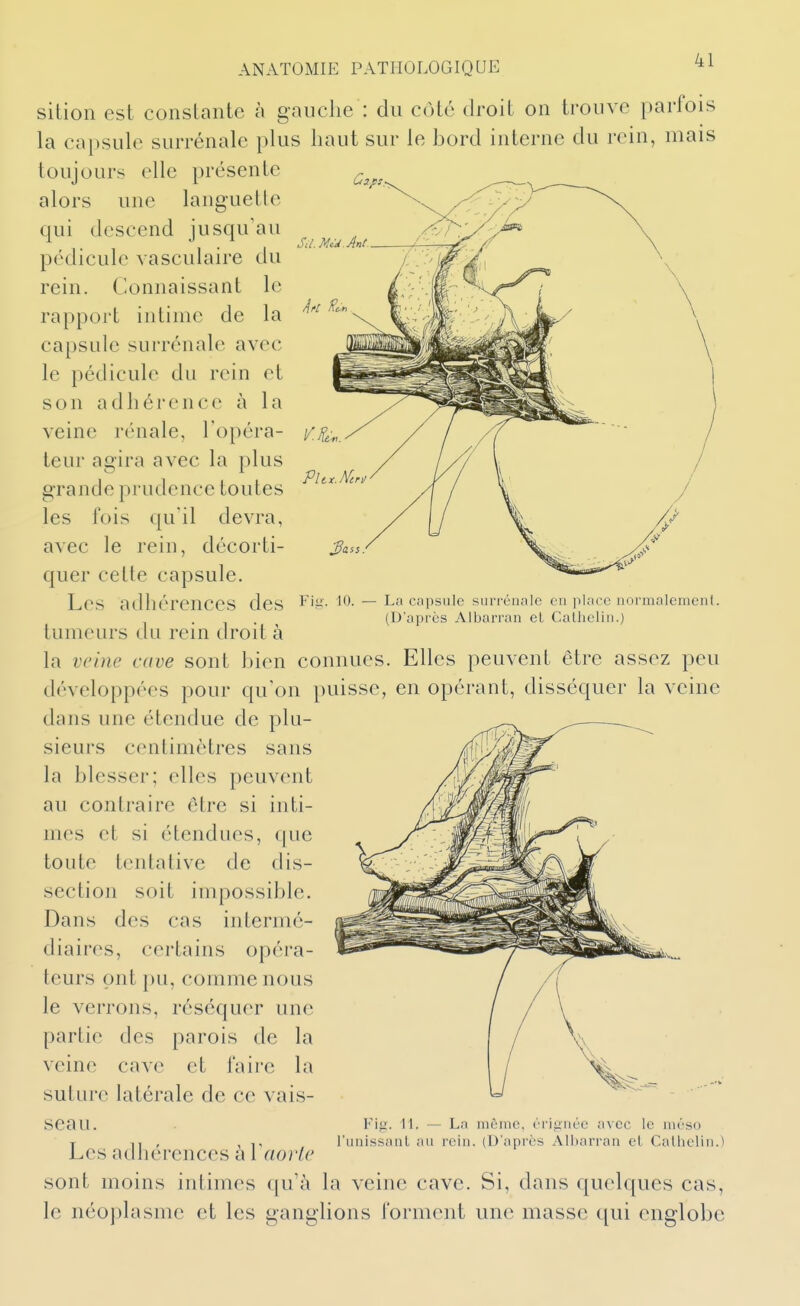 S.l.McJ.Ant. La capsule surrénale en place normalemen!. (D'après Albarran et Calhelin.) ANATOMIE PATHOLOGIQUE ^1 sition est constante à gauche : du coté droit on trouve parfois la capsule surrénale plus haut sur le hord interne du rein, mais toujours elle présente alors une languette qui descend jusqu'au pédicule vasculaire du rein. Connaissant le rapport intime de la capsule surrénale avec le pédicule du rein et son adhérence à la veine rénale, l'opéra- teur agira avec la plus grande prudence toutes les fois qu'il devra, avec le rein, décorti- quer cette capsule. Les adhérences des fig. lo tumeurs du rein droit à la veine cave sont hien connues. Elles peuvent être assez peu développées pour qu'on puisse, en opérant, disséquer la veine dans une étendue de plu- sieurs centimètres sans la hlesser; elles peuvent au contraire être si inti- mes et si étendues, que toute tentative de dis- section soit impossible. Dans des cas intermé- diaires, certains opéra- teurs ont pu, comme nous le verrons, réséquer une partie des parois de la veine cave et faire la suture latérale de ce vais- seau. Les adhérences à Vaorle sont moins intimes qu'à la veine cave. Si, dans quelques cas, le néoplasme et les ganglions forment une masse qui englobe FiK- 11. — La même, ériiînée n\GC le niéso runissanl au rein. (D'après Albarran cl Calhelin.)