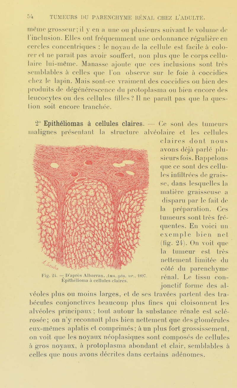 mrmo i>Toss('ur ; il y en a une ou plusioui's suivant lo voliiiiio de 1 inclusion. Ell(>s oui l'rcqu(Mnmonl une ordonnance régulière en cercles concenlri(|ues : le noyau de la cellule est facile à colo- i-er cl ne j)arail pas avoir soufferl, non plus (|ue le corps cellu- laire lui-même. Manasse ajoule (jue ces inclusions sont très seml)lal)les à celles <pie Ton observe sur le foie à coccidies chez le lapin. Mais sont-ce vi'aiment des coccidies ou bien des [)ro(luils de dégénérescence du [)rotoplasma ou l)ien encore des leucocytes ou des cellules lilles ? Il ne paraît pas que la ques- tion soit encore tranchée. 2 Epithéliomas à cellules claires. — (le sont des tumeurs malignes présenlanl la slruclure alvéolaire et les cellules claires dont nous l r-^^ avons déjà parlé plu- 4 sieurs fois. Rappelons ^i^; -$ que ce sont des cellu- les inhlti-ées de grais- se, dans lesquelles la matièi'e graisseuse a disparu par le l'ait de la préparation. Ces tumeurs sont ti'ès fré- quentes. En voici un exemple bien nel (lig. On voil que la tumeur est très nettement limitée du c(Mé du parenchyme rénal. Le tissu con- jonclif forme des al- véoles plus ou moins larges, et de ses travées partent des li-a- bécules conjonctives beaucoup plus fines qui cloisonnent les alvéoles principaux; tout autour la substance rénale est sclé- rosée; on n'y reconnaît plus bien nettement que des glomérules eux-mêmes aplatis et comprimés; à un plus fort grossissement, on voit que les noyaux néoplasiques sont composés de cellules à gros noyaux, à {)rotoplasma abondant et claii-, semblables à celles que nous avons décrites dans certains adénomes.