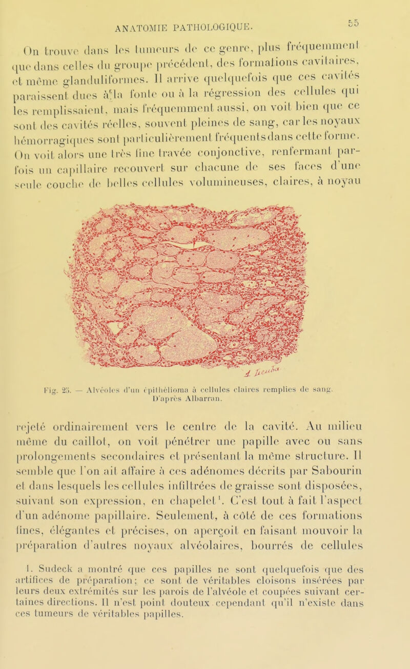On trouvr dans 1rs IniiKnirs dr ce gonro, plus frcMiueinmonl que dans celles du groui)e |»i'écé(lenl, des formalions cavdaires, et même glandulifoi-mes. Il airive quelquefois ([ue ces cavités paraissent dues à'ia l'oide ou à la régression des cellules (|ui les reuqilissaieni, mais IVéquemment aussi, on voit l)ien (jue ce sont des cavités ré(dl(^s, souvent pleines de sang, car les noyaux hémorragiques sont [»ai-l iculièi-(Mnent IVéquentsdans celte forme. On voit alors une très line travée conjonctive, renfermant par- fois un capillaire recouverl sur (diacune de ses faces d\in(^ seide couche i\r Ixdles cellules volumineuses, claires, à noyau Fig. '2,'i. — Alvi'olcs (l'un < pilhéliomii ù cL'llules chiiics remplies tle sang. D'après All)arrari. rejeté ordinairement vers le centre de la cavité. Au milieu même du caillot, on voit pénétrer une papille avec ou sans [)rolongeinents secondaires et [)résentant la même structure. Il sendjle que l'on ail aifaire à ces adénomes décrits par Sabourin et dans lesquels les cellules intiltrées dégraisse sont disposées, suivant son ex[)ression, en chapelet', ('/(«si tout à fait l'aspect d'un adénome papillairc. Seulement, à coté de ces formations Unes, élégantes et précises, on aperçoit en faisant mouvoir la pré[)aration d'autres noyaux alvéolaires, bourrés de cellules 1. Siicleck a nioiilré que ces papilles ne sont (iuel(iucfois que des artifices de préparation; ce sont de véritables cloisons insérées par leurs deux extrémités sur les pai'ois de l'alvéole et coupées suivant cer- taines directions. Il nVst ])oinl douteux cependant qu'il n'existe dans ces tumeurs de vérilaijies |)apilles.