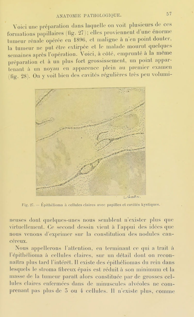 Voici une préparation dans laquelle on voit plusieurs de ces formations papillaires (tig. 27); elles proviennent d'une énorme tumeur rénale opérée en 18!)(), et maligne à n'en point douter, la tumeur ne put être extirpée et le malade mourut quelques semaines après l'opération. Voici, à côté, emprunté à la même préparation et à un plus fort grossissement, un point appar- tenant à un noyau en apparence plein au premier examen (fig. 28). On y voit bien des cavités régulières très peu volumi- Fig. '27. — Epithélioma à cellules rlaircs avec papilles el cavilès kystiques. neuses dont quelques-unes nous semblent n'exister plus que virtuellement. Ce second dessin vient à rap[)ui des idées que nous venons d'exprimer sur la constitution des nodules can- céreux. Nous ap[)ellerons l'attenlion, en b^rminant ce qui a trait à l'épitliélioma à cellules claires, sur un détail dont on recon- naîtra |)lus tard l'intérêt. Il existe des épitliéliomas du rein dans lesquels le stroma (iljreux épais est réduit à son uiinimum et la masse de la tumeur paraît alors constituée par de grosses cel- lules claires enfermées dans de minuscules alvéoles ne com- prenant pas plus de 5 ou 4 cellules. 11 n'existe plus, comme