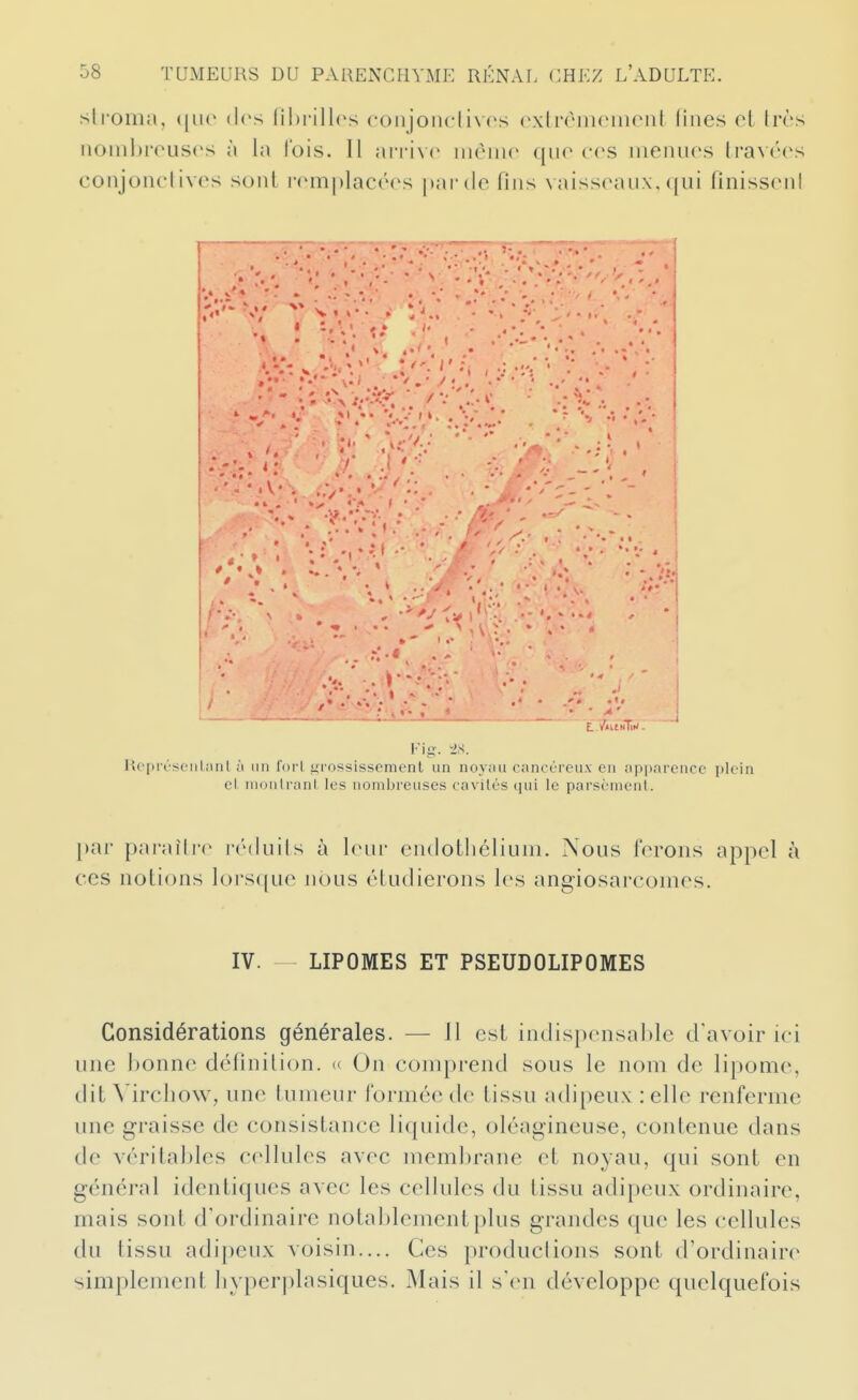 slroiiia, ([lie des lihi illcs conjoncli\es cxlronKMiirnl (ines el Irès noinljrous('s à la lois. Il aiTi\r inèiii(> qiio ces nieiuirs travées conjonclivos sont romplacéos |»ar(le fins \ aissraiix. ((iii finiss(Mil s. t % • • . • • 1 • ». t.» •.1* ' ï.'ï'îitH!ii<.' Rc'pi-rseïliant ;i un forl grossissement un noyau cancéi'eux en apparence plein cl nionirani les nombreuses cavilés qui le parsèmcnl. [)ar paraître réduits à leur eiulotliétiuni. Nous ferons appel à CCS notions lorsque nous étudierons les angiosarcomes. IV. — LIPOMES ET PSEUDOLIPOMES Considérations générales. — 11 est indispensable d'avoir ici une bonne définition. « On comprend sous le nom de lipome, dit Vircliow, une tumeur formée de tissu adipeux : elle renferme une graisse de consistance liquide, oléagineuse, contenue dans de véritables cellules avec membrane et noyau, qui sont en général identiques avec les cellules du tissu adipeux ordinaire, mais sont d'ordinaire notal)lementplus grandes que les cellules du tissu adipeux voisin.... Ces productions sont d'ordinaire simplemeut byperplasiques. Mais il s'en développe quelquefois