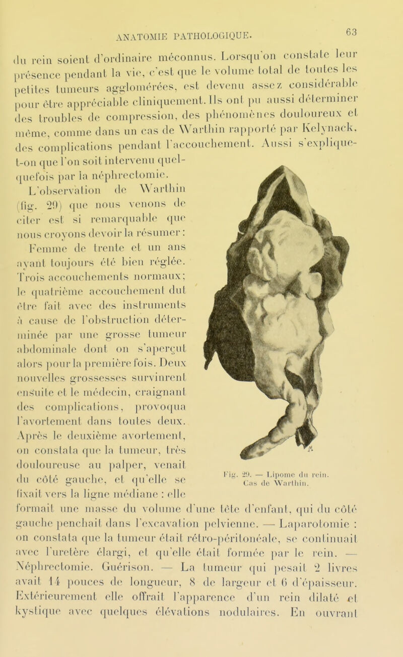 (lu rein soient dordinaire méconnus. Lorsqu'on consLalc leur lu-ésence pendant la vie, eVst que le volume lolal de loules les petites tumeurs aggloinérces, est dev(MKi assez considérable pour être apprécial)le cliniquement. Us onl pu aussi détermme]' des troubles de compression, des pliénomènes douloureux et même, comme dans un cas de Warthin rapporté par Kelynack, des complications pendant baccoucbement. Aussi s'explique- t-on que l'on soit intervenu quel- quefois par la népbrectomi(\ Lobservation de Wartbin (lig-. 20) que nous venons de citer est si remarquable que nous croyons devoir la résumer : Femme de trente et un ans Myant toujours été bien réglée. Trois accouchements normaux; le quatrième accouchement dut être fait avec des instruments à cause de 1 obstruction déter- minée par une grosse tumeur abdominale dont on s'aperçut alors pour la première l'ois. Deux nouvelles grossesses survinrent ens\iite et le médecin, craignant des complications, provoqua l'avortement dans toutes deux. Après le deuxième avortemenl, on constata que la tumeiu-, li-ès douloureuse au palper, venait du côté gauche, et qu'elle se fixait vers la ligne médiane : elle formait une masse du volume d'une UMe d'eid'anl, qui du côté gauche penchait dans l'excavation pelvienne. — Laparotomie : on constata ([ue la tumeur ébiit rétro-péritonéale, se continuait avec l'uretère élargi, et qu'elle était formée pai- le rein. — Néphrectomie. Guérison. — La lumeur (pii pesait 2 livres avait 14 pouces de longucun-, (S de lai'gcui- et () d'épaisseur. Extérieurement elle offrait l'apparence d'un rein dilaté el kystique avec quelques élévations nodulaires. En ouvrant l'ii ■i'.i. — IJpoine (lu rt'iii. C.jis (le SVni'Iliiii.