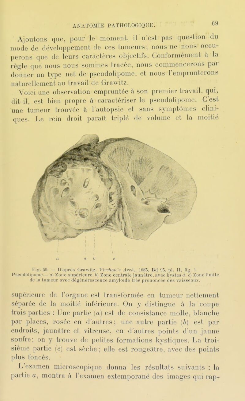 Ajoutons qiio, pour le moment, il n est pas question du mocie de développement de ces tumeurs; nous ne nous occu- perons que de leurs caractères objectifs. Conformément à la règle que nous nous sommes tracée, nous commencerons par donner un type net de pseudolipome, et nous l'emprunterons naturellement au travail de Grawitz. Voici une observation empruntée à son premier travail, qui, dit-il, est bien propre à caractériser le pseudolipome. C'est une tumeur trouvée à l'autopsie et sans symptômes clini- ques. Le rein droit paraît triplé de volume et la moitié / a cl b c Fi g. 30. — D'après Grawilz. Virchoiv'f; Arch., 1SSÔ, Rd 90, pl. Il, (ii?. I. Pseudolipome.— a) Zone supérieure, h) Zone centrale jnun;il rc, avec kystes (/. c) Zone limilo de la tumeur avec dégénérescence amyloïde très prononcée des vaisseaux. supérieure de Torgane est transformée en tumeui' nettement séparée de la moitié inférieure. On y distingue à la coupe trois parties : Une partie («) est de consistance molle, blanche par places, rosée en d'autres; une autre partie (b) est par endroits, jaunâtre et vitreuse, en d'autres points d'un jaune soufre; on y trouve de petites formations kystiques. La troi- sième partie (c) est sèche; elle est rougeàtre, avec des points plus foncés. L'examen microscopique donna les résultats suivants : la partie a, montra à l'examen extemporané des images qui rap-