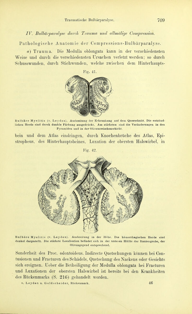 IV. Bulbärparalyse durch Trauma und allmälige Cornpression. Pathologische Anatomie der Compressions-Bulbilrparalyse. a) Trauma. Die Medulla oblongata kann in der verschiedensten Weise und durch die verschiedensten Ursachen verletzt werden; so durch Schusswunden, durch Stichmmden. welche zwischen dem Hinterhaupts- Fig. 41. Bulbäre Myelitis (v. Leydeii). Ausbreitung der Erkranlvung auf dem Querschnitt. Die entzünd- lichen Herde sind durch dunkle Färbung ausgedrückt. Am stärksten sind die Veränderungen in den Pyr.amiden und in der Olivenzwischenschicht. bein und dem Atlas eindringen, durch Knochenbrüche des Atlas, Epi- stropheus, des Hinterhauptsbeines, Luxation der obersten Halswirbel, in Fig. 42. Bulbäre Myelitis (v. Leyden). Ausbreitung in der Höhe. Die hämorrhagischen Herde sind dunkel dargestellt. Die stärkste Localisation befindet sich in der unteren Hälfte der Hautengrube, der Olivengegend entsprechend. Sonderheit des Proc. odontoideus. Indirecte Quetschungen können bei Con- tusionen und Fracturen des Schädels, Quetschung des Nackens oder Gesichts sich ereignen, üeber die Belheiligung der Medulla oblongata bei Fracturen und Luxationen der obersten Halswirbel ist bereits bei den Krankheiten des Eückenmarks (S. 216) gehandelt worden. V, Leyden u. G o 1 d s c he i d e r, KUckenmark, 46