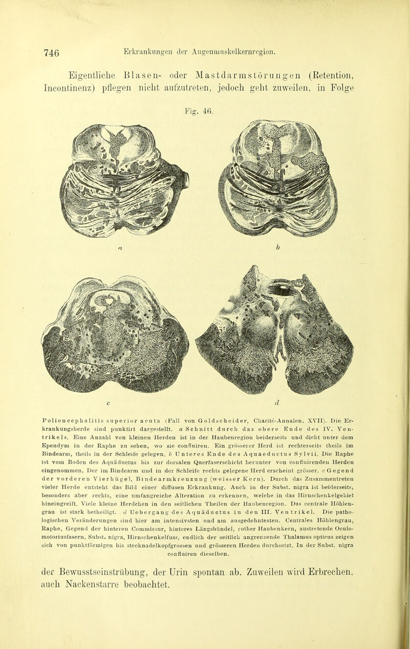 Eigentliche Blasen- oder Mastdarmstörungen (Eetention, Incontinenz) pflegen nicht aufzutreten, jedoch geljt zuweilen, in Folge Fig. 46. PolieucephaIitis superior acuta (Fall von Go 1 dacheider, Cliarite-Anualen. XVII). Die Br- krankungsherde sind punktirt dargestellt, a Schnitt durch das obere Ende des IV. Ven- trikels. Eine Anzahl von kleinen Herden ist in der Haubenregion beiderseits und dicht nnter dem Ependym in der Kaphe zu .sehen, wo sie confluiren. Ein grosserer Herd ist rechterseits theils im Bindearm, theils in der Schleife gelegen, h Unteres Ende des Aquaeductus Sylvii. Die Kaphe ist vom Boden des Aquäductus bis zur dorsalen Querfaserschicht herunter von confiuirenden Herden eingenommen. Der im Bindearm und in der Schleife rechts gelegene Herd erscheint grösser. «Gegend der vorderen Vierhügel, Bindearmkreuzun g (weisser Kern). Durch das Zusammentreten vieler Herde entsteht das Bild einer diffusen Erkrankung. Auch in der Snbst. nigra ist beiderseits, besonders aber rechts, eine umfangreiche Alteration zu erkennen, welche in das Hirnschenkelgebiet hineingreift. Viele kleine Herdchen in den seillichen Theilen der Haubenregion. Das centrale Höhlen- grau ist stark betheiligt, d Uebergang des Aquäductus in den III. Ventrikel. Die patho- logischen Veränderungen sind hier am intensivsten und am ausgedehntesten. Centrales Höhlengrau, Raphe, Gegend der hinteren Commissur, hinteres Längsbündel, rother Haubenkern, austretende Oculo- motoriusfasern, Subst. nigra, Hirnschenkelfuss, endlich der seitlich angrenzende Thalamus opticus zeigen sich von punktförmigen bis stecknadelkopfgrossen und grösseren Herden durchsetzt. In der Subst. nigra confluiren dieselben. der Bewusstseinstrübung, der Urin spontan ab. Zuweilen wird Erbrechen, auch Nackenstarre beobachtet.