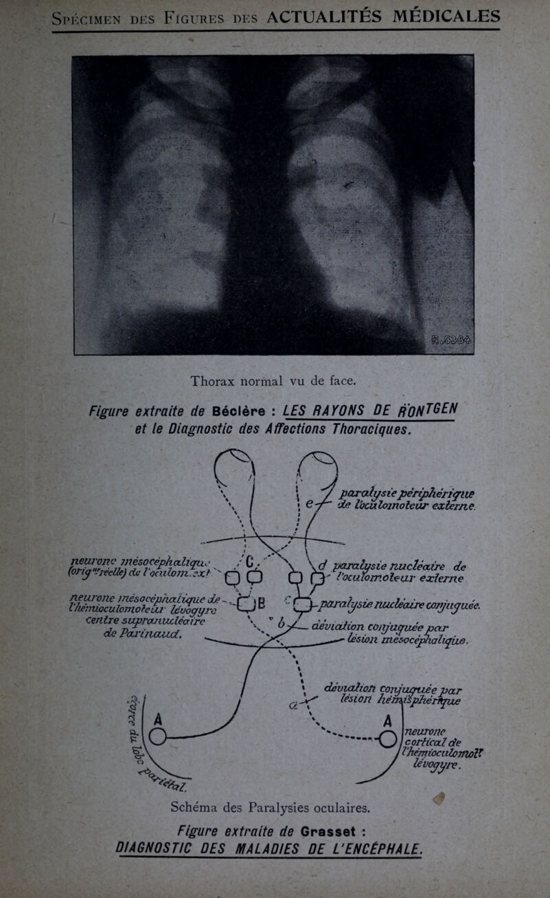 Thorax normal vu de face. Figure extraite de Béclère : LES RAYONS DE r'qnTGEN et le Diagnostic des Affections Thoraciques. \ / paralysiepériphérique e-f~ de loculojnolear externe d paralysie nucléaire de l'oculomoleur externe neurone mésocéphaliqtxe : C • ‘ * (oriy .'réelle) de l’oculom.exl^ 0 neurone mésocêpruzîique de -, .jri s p l'héniioculomolelu lévogyre D centre supranucléaire \ r £ de Parinaud. paralysie nucléaire cojyuyuée. déviation coty agitée par lésion mesocéphalupjue. neurone cortical de l'hèrnioculonioV lévogyre. Schéma des Paralysies oculaires. Figure extraite de Grasset : DIAGNOSTIC DES MALADIES DE L’ENCÉPHALE.