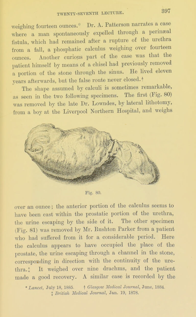 weighing fourteen ounces.* Dr. A. Patterson narrates a case where a man spontaneously expelled through a perineal fistula, which had remained after a rupture of the urethra from a fall, a phosphatic calculus weighing over fourteen ounces. Another curious part of the case was that the patient himself by means of a chisel had previously removed a portion of the stone through the sinus. He lived eleven years afterwards, but the false route never closed.i The shape assumed by calculi is sometimes remarkable, as seen in the two following specimens. The first (Fig. 80) was removed by the late Dr. Lowndes, by lateral lithotomy, from a boy at the Liverpool Northern Hospital, and weighs over an ounce; the anterior portion of the calculus seems to have been cast within the prostatic portion of the urethra, the urine escaping by the side of it. The other specimen (Fig. 81) was removed by Mr. Kushton Parker from a patient who had suffered from it for a considerable period. Here the calculus appears to have occupied the place of the prostate, the urine escaping through a channel in the stone, corresponding in direction with the continuity of the ure- thra.! It weighed over nine drachms, and the patient made a good recovery. A similar case is recorded by the * Lancet, July 18, 1885. t Glasgow Medical Journal, June, 1884.