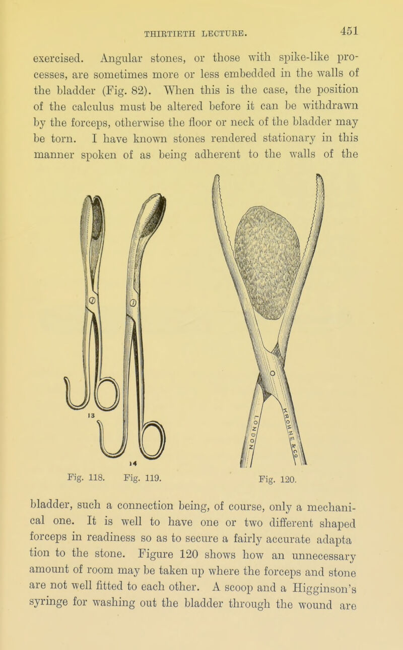 exercised. Angular stones, or those with spike-like pro- cesses, are sometimes more or less embedded in the walls of the bladder (Fig. 82). When this is the case, the position of the calculus must be altered before it can be withdrawn by the forceps, otherwise the floor or neck of the bladder may be torn. I have known stones rendered stationary in this manner spoken of as being adherent to the walls of the Fig. 118. Fig. 119. Fig. 120. bladder, such a connection being, of course, only a mechani- cal one. It is well to have one or two different shaped forceps in readiness so as to secure a fairly accurate adapta tion to the stone. Figure 120 shows how an unnecessary amount of room may be taken up where the forceps and stone are not well fitted to each other. A scoop and a Higginson's syringe for washing out the bladder through the wound are