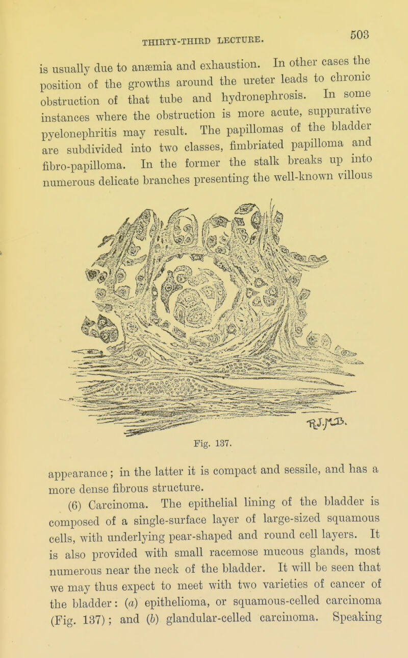 is usually clue to anemia and exhaustion. In other cases the position of the growths around the ureter leads to chronic obstruction of that tube and hydronephrosis. In some instances where the obstruction is more acute, suppurative pyelonephritis may result. The papillomas of the bladder are subdivided into two classes, fimbriated papilloma and fibro-papilloma. In the former the stalk breaks up into numerous delicate branches presenting the well-known villous Fig. 137. appearance; in the latter it is compact and sessile, and has a more dense fibrous structure. (6) Carcinoma. The epithelial lining of the bladder is composed of a single-surface layer of large-sized squamous cells, with underlying pear-shaped and round cell layers. It is also provided with small racemose mucous glands, most numerous near the neck of the bladder. It will be seen that we may thus expect to meet with two varieties of cancer of the bladder: (a) epithelioma, or squamous-celled carcinoma (Fig. 137); and (b) glandular-celled carcinoma. Speaking