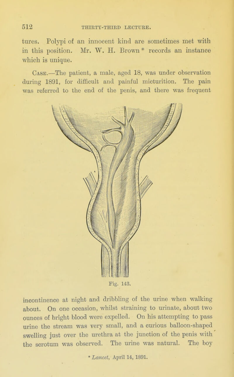 hires. Polypi of an innocent kind are sometimes met with in this position. Mr. W. H. Brown * records an instance which is unique. Case.—The patient, a male, aged 18, was under observation during 1891, for difficult and painful micturition. The pain was referred to the end of the penis, and there was frequent Fig. 143. incontinence at night and dribbling of the urine when walking about. On one occasion, whilst straining to urinate, about two ounces of bright blood were expelled. On his attempting to pass urine the stream was very small, and a curious balloon-shaped swelling just over the urethra at the junction of the penis with the scrotum was observed. The urine was natural. The boy * Lancet, April 14, 1891.