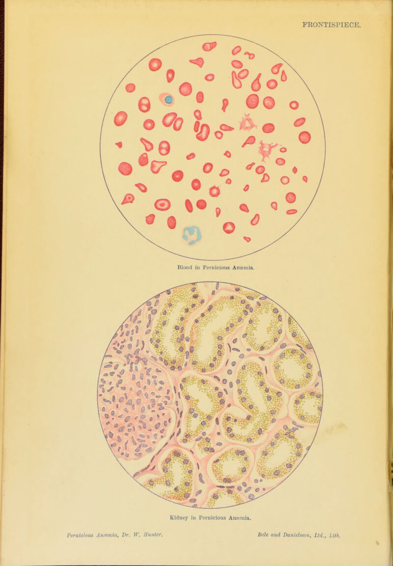FRONTISPIECE. Blood in Pernicious Anaemia. Kidney in Pernicious Anaemia. Perniciom Anrcmia, Dr. W. Hunter. Bale and Danielsson, Ltd., I.ith.