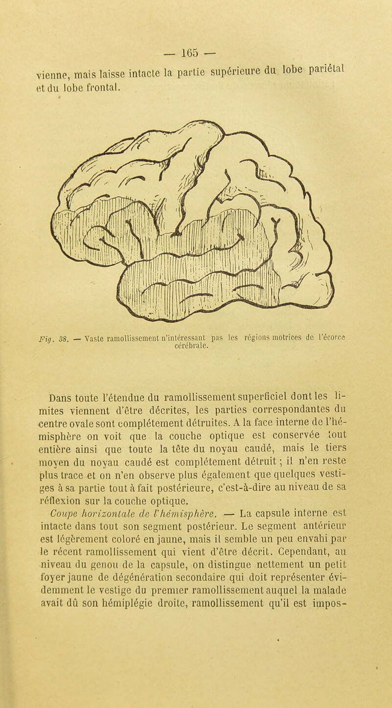 vienne, mais laisse intacte la partie supérieure du lobe par et du lobe frontal. Fin. 38. — Vaste ramollissement n'intéressant pas les régions motrices de l'écorce cérébrale. Dans toute l'étendue du ramollissement superficiel dont les li- mites viennent d'être décrites, les parties correspondantes du centre ovale sont complètement détruites. A la face interne de l'hé- misphère on voit que la couche optique est conservée tout entière ainsi que toute la tête du noyau caudé, mais le tiers moyen du noyau caudé est complètement détruit ; il n'en reste plus trace et on n'en observe plus également que quelques vesti- ges à sa partie tout à fait postérieure, c'est-à-dire au niveau de sa réflexion sur la couche optique. Coupe horizonlale de Vhémisphère. —• La capsule interne est intacte dans tout son segment postérieur. Le segment antérieur est légèrement coloré en jaune, mais il semble un peu envahi par le récent ramollissement qui vient d'être décrit. Cependant, au niveau du genou de la capsule, on distingue nettement un petit foyer jaune de dégénération secondaire qui doit représenter évi- demment le vestige du premier ramollissement auquel la malade avait dû son hémiplégie droite, ramollissement qu'il est impos-