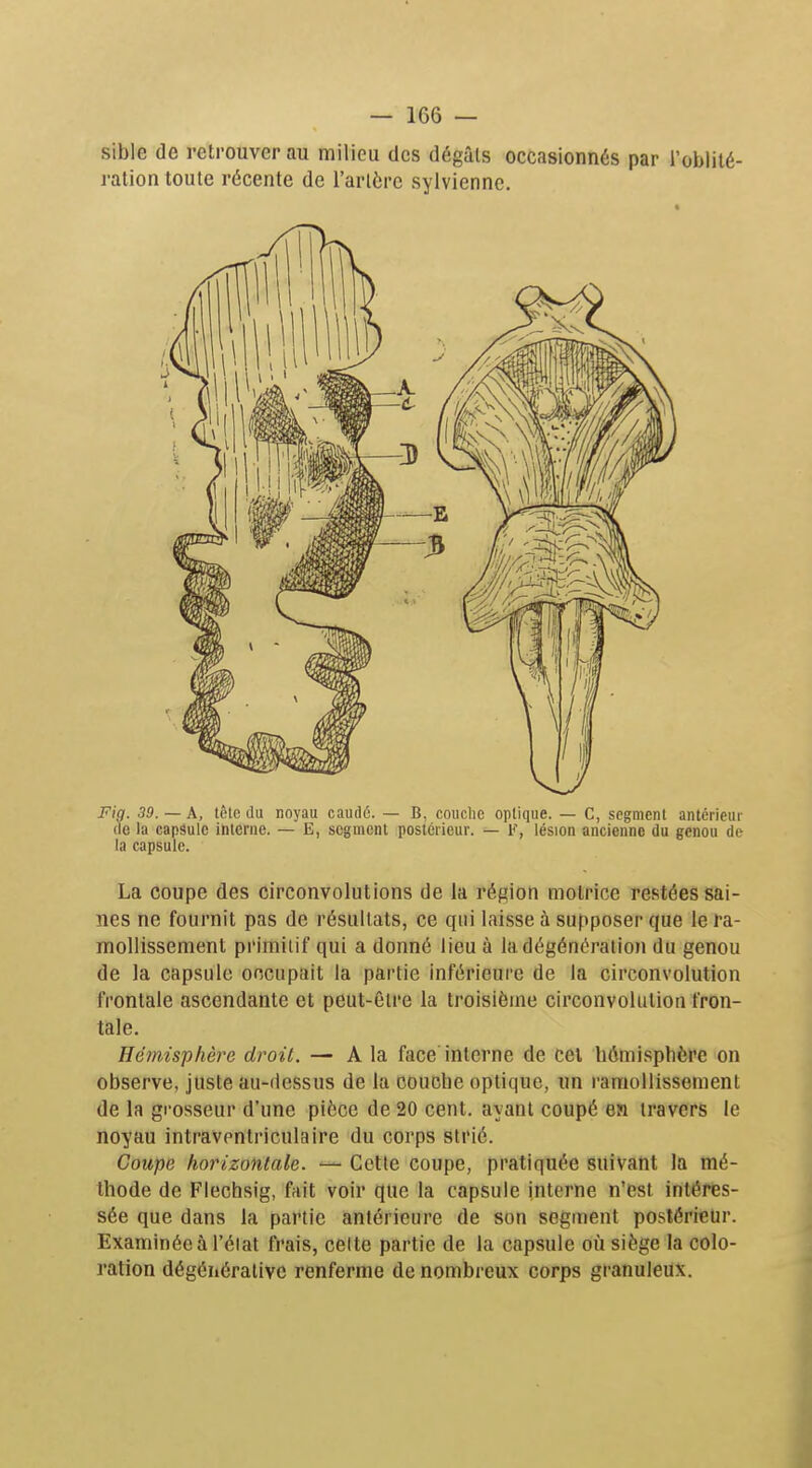 sible de retrouver au milieu des dégâts occasionnés par l'oblilé- ration toute récente de l'artère sylvienne. Fig. 39. — A, tête du noyau caudé. — B, couche optique. — C, segment antérieur de la capsule interne. — E, segment postérieur. — F, lésion ancienne du genou de la capsule. La coupe des circonvolutions de la réf^ion motrice restées sai- nes ne fournit pas de résultats, ce qui laisse à supposer que le ra- mollissement primitif qui a donné lieu à la dégénéraiion du genou de la capsule occupait la partie inférieure de la circonvolution frontale ascendante et peut-être la troisième circonvoliitioti fron- tale. Hémisphère droit. — A la face'interne de cet hémisphère on observe, juste au-dessus de la couche optique, un ramollissement de la grosseur d'une pièce de 20 cent, ayant coupé en travers le noyau intraventriculaire du corps strié. Coupe horizontale. — Cette coupe, pratiquée suivant la mé- thode de Flechsig, fait voir que la capsule interne n'est intéres- sée que dans la partie antérieure de son segment postérieur. Examinée à l'éiat frais, celte partie de la capsule où siège la colo- ration dégéhéraiive renferme de nombreux corps granuleux.