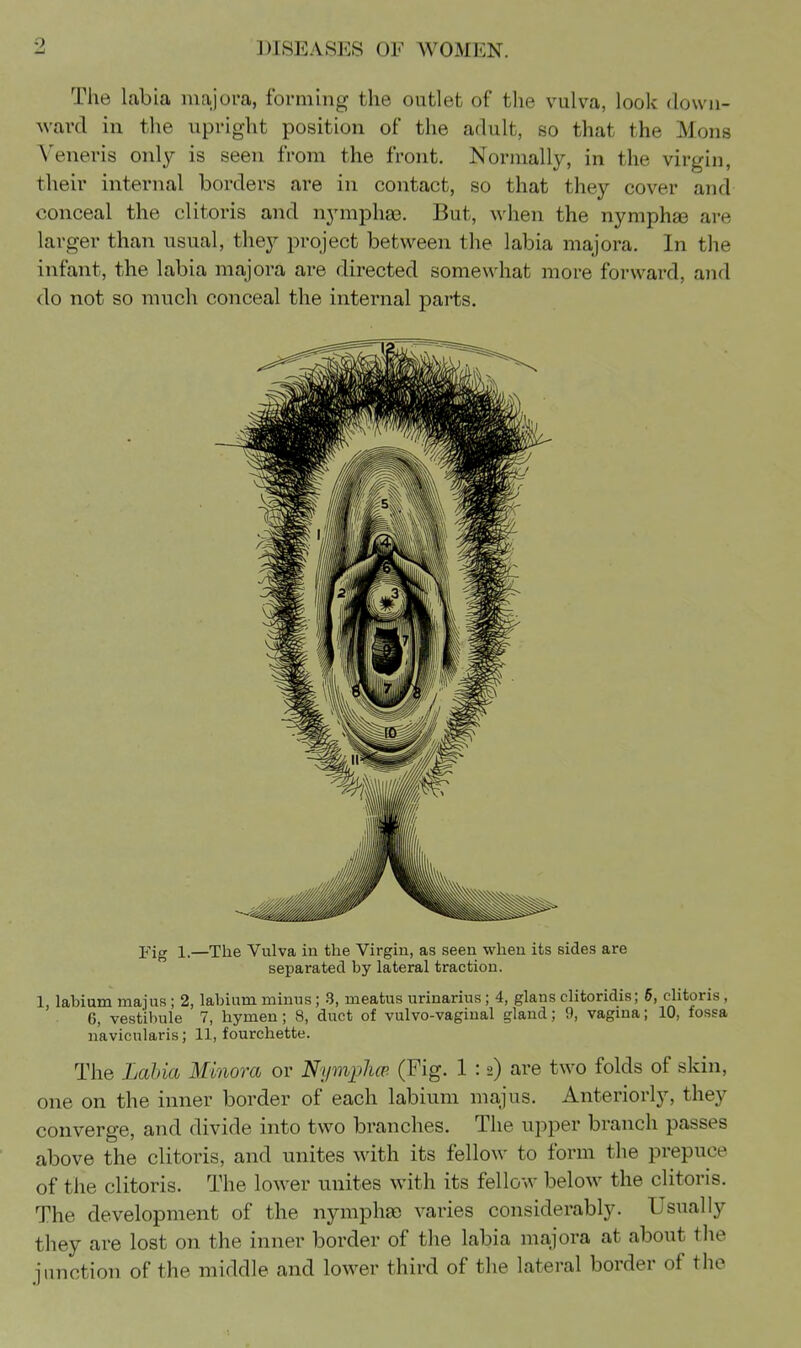 The labia iiiajora, forming the outlet of the vulva, look down- ward in the upright position of the adult, so that the Mons Veneris only is seen from the front. Normally, in the virgin, their internal borders are in contact, so that they cover and conceal the clitoris and nymphaB. But, when the nymphee are larger than usual, they project between the labia majora. In the infant, the labia majora are directed somewhat more forward, and do not so much conceal the internal parts. Fig 1.—The Vulva in the Virgin, as seen when its sides are separated by lateral traction. 1, labium mains; 2, labium minus; 3, meatus urinarius; 4, glans clitoridis; 6, cHtoris , 6, vestibule 7, hymen; 8, duct of vulvo-vagiual gland; 9, vagma; 10, fossa n'avicularis; 11, fourchette. The Labia Minora or Nymplm (Fig. 1 :2) are two folds of skin, one on the inner border of each labium majus. Anteriorly, they converge, and divide into two branches. The upper branch passes above the clitoris, and unites with its fellow to form the prepuce of the clitoris. The lower unites with its fellow below the clitoris. The development of the nymphgc varies considerably. Usually they are lost on the inner border of the labia majora at about the iunction of the middle and lower third of the lateral border of the