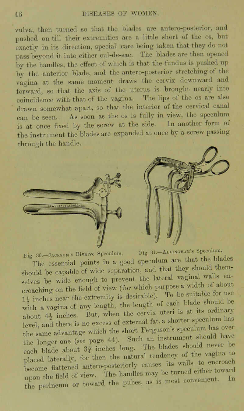 vulva, then tiu-ned so that the blades are antero-posterioi', and pushed on till their extremities are a little short of the os, but exactly in its direction, special care being taken that they do not pass beyond it into either cul-de-sac. The blades are then opened by the handles, the effect of which is that the fundus is pushed up by the anterior blade, and the antero-posterior stretching of the vagina at the same moment draws the cervix downward and for'ward, so that the axis of the uterus is brought nearly into coincidence with that of the vagina. The lips of the os are also drawn somewhat apart, so that the interior of the cervical canal can be seen. As soon as the os is fully in view, the speculum is at once fixed by the screw at the side. In another form of the instrument the blades are expanded at once by a screw passing through the handle. rig 30.-Jackson's Bivalve Speculum, Fig. 31.-Ai.LiNaH.M's Speculuu, The essential points in a good speculum are that the b ades should be capable of wide separation, and that they should them- selves be wide enough to prevent the lateral ^-g^f ^ J croaching on the field of view (for which purpose a width of about iMnchef near the extremity is desirable). To be suitable for use vltratgina of any length, the length of each blade sh^^^^^^^^^ about 41 inches. But, when the cervix uteri is at its ordmaiy level and there is no excess of external fat, a shorter speculum has the same advantage which the short Ferguson's speculum has over the longer one {see page 44). Such an instrument should have a h bl!de about inches long. The blades should n.^.- b T>laced laterally, for then the natural tendency of the vagina to becont fla^^^^^^^^^ antero-posteriorly causes its wal s to encroach Z the M of view. The handles may be turned either toward Z ,X^ or toward the pubes, as is most convenient. In